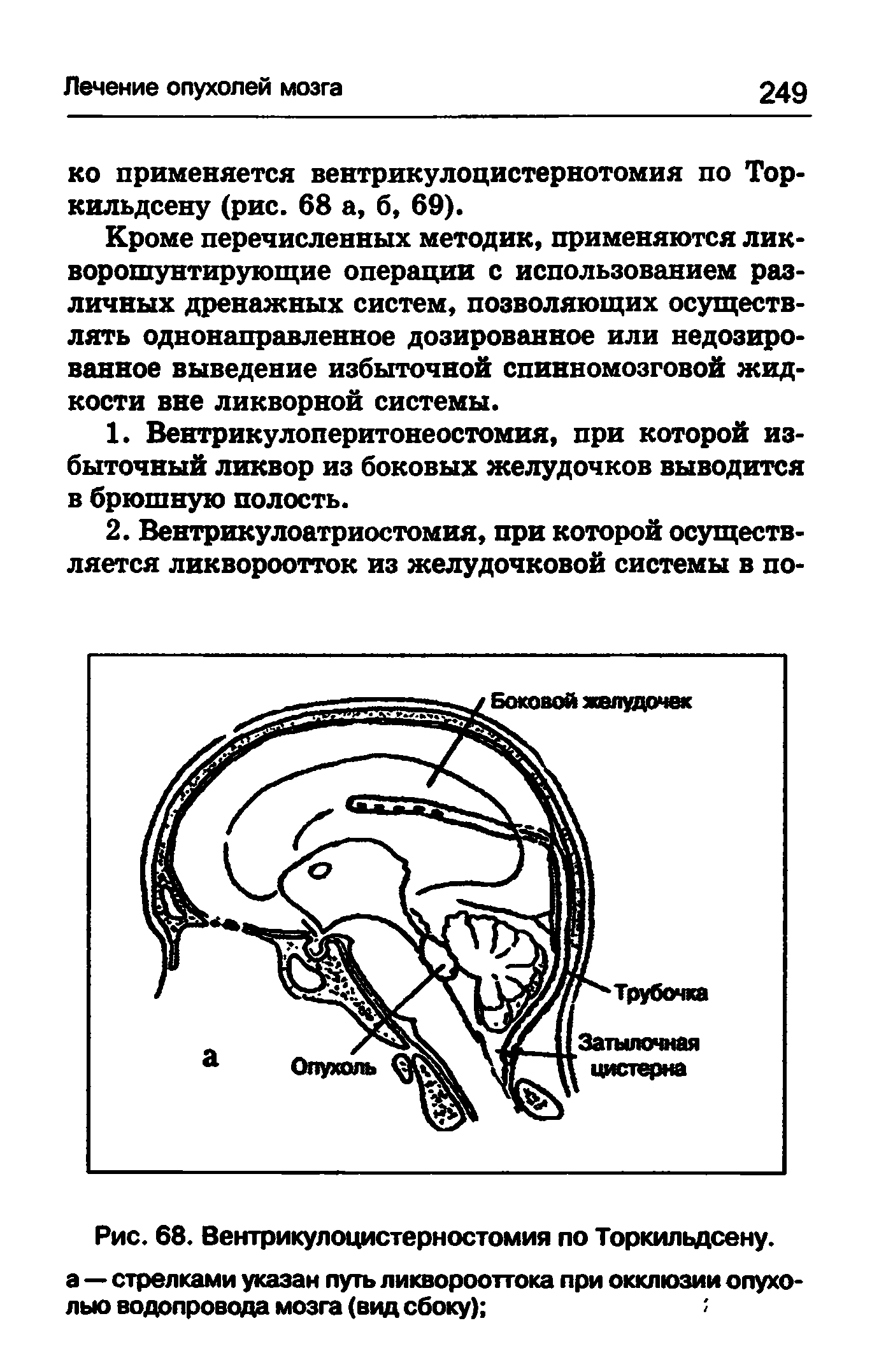 Рис. 68. Вентрикулоцистерностомия по Торкильдсену, а — стрелками указан путь ликворооттока при окклюзии опухолью водопровода мозга (вид сбоку) ...