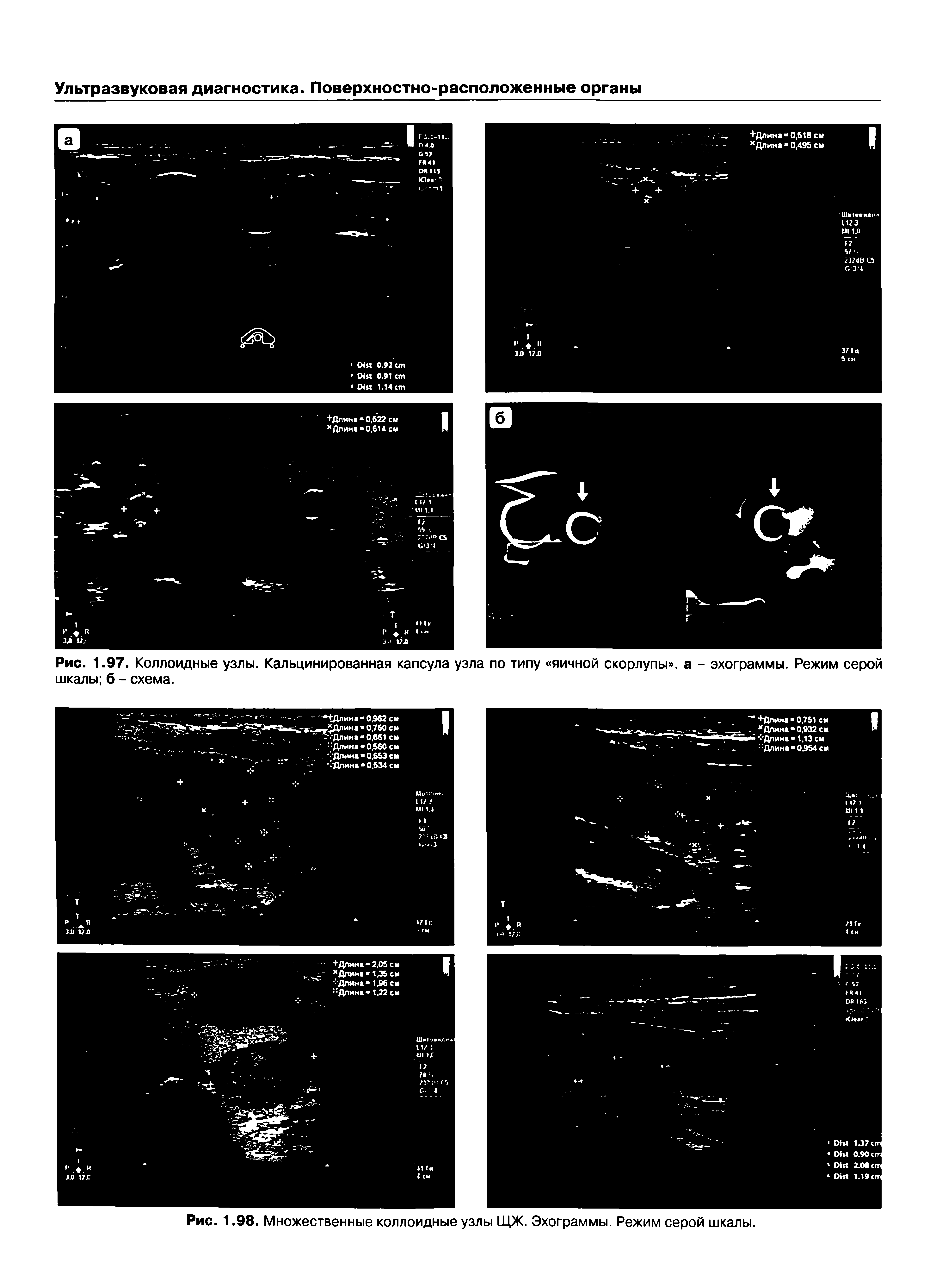 Рис. 1.97. Коллоидные узлы. Кальцинированная капсула узла по типу яичной скорлупы , а - эхограммы. Режим серой шкалы б - схема.