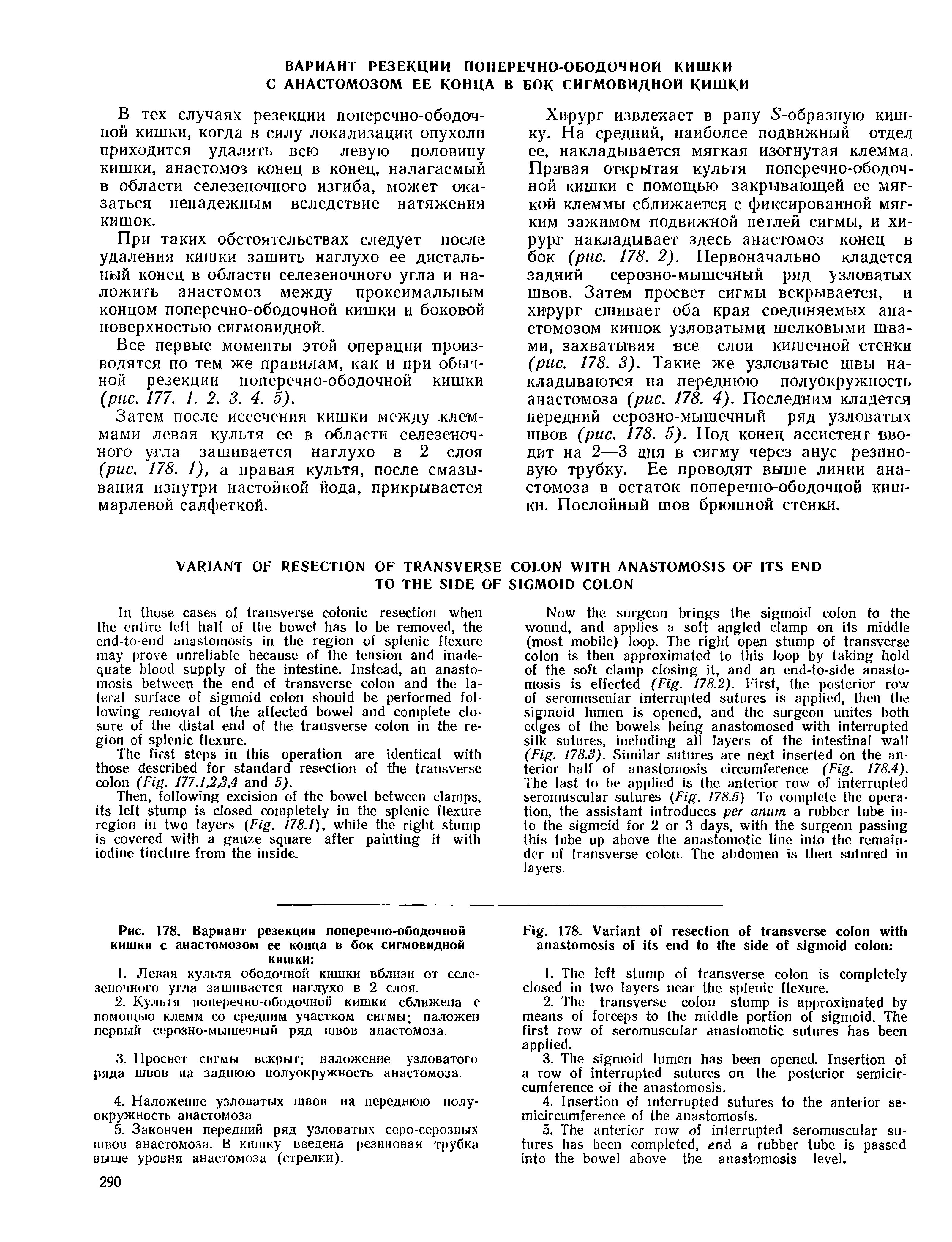 Рис. 178. Вариант резекции поперечно-ободочной кишки с анастомозом ее конца в бок сигмовидной кишки ...