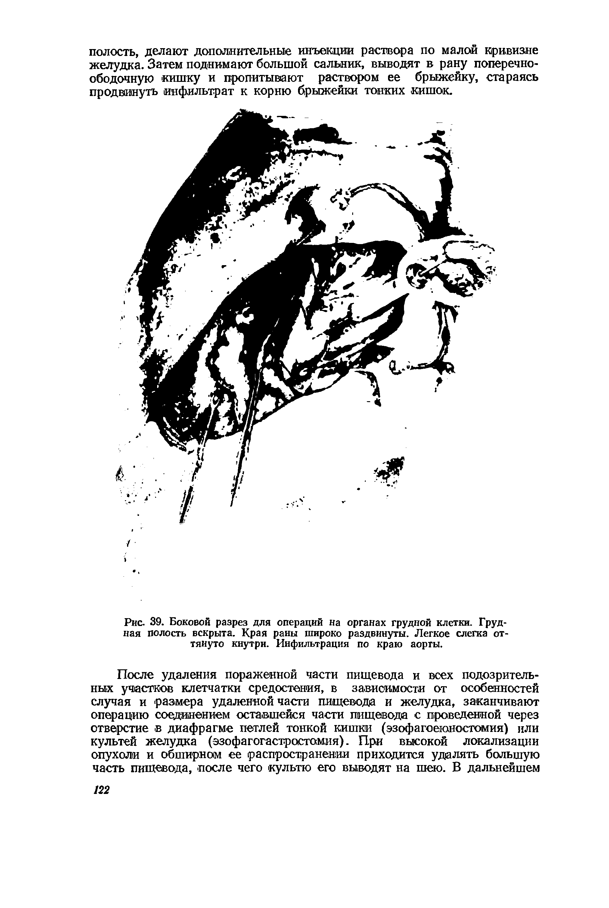 Рис. 39. Боковой разрез для операций на органах грудной клетки. Грудная полость вскрыта. Края раны широко раздвинуты. Легкое слегка оттянуто кнутри. Инфильтрация по краю аорты.