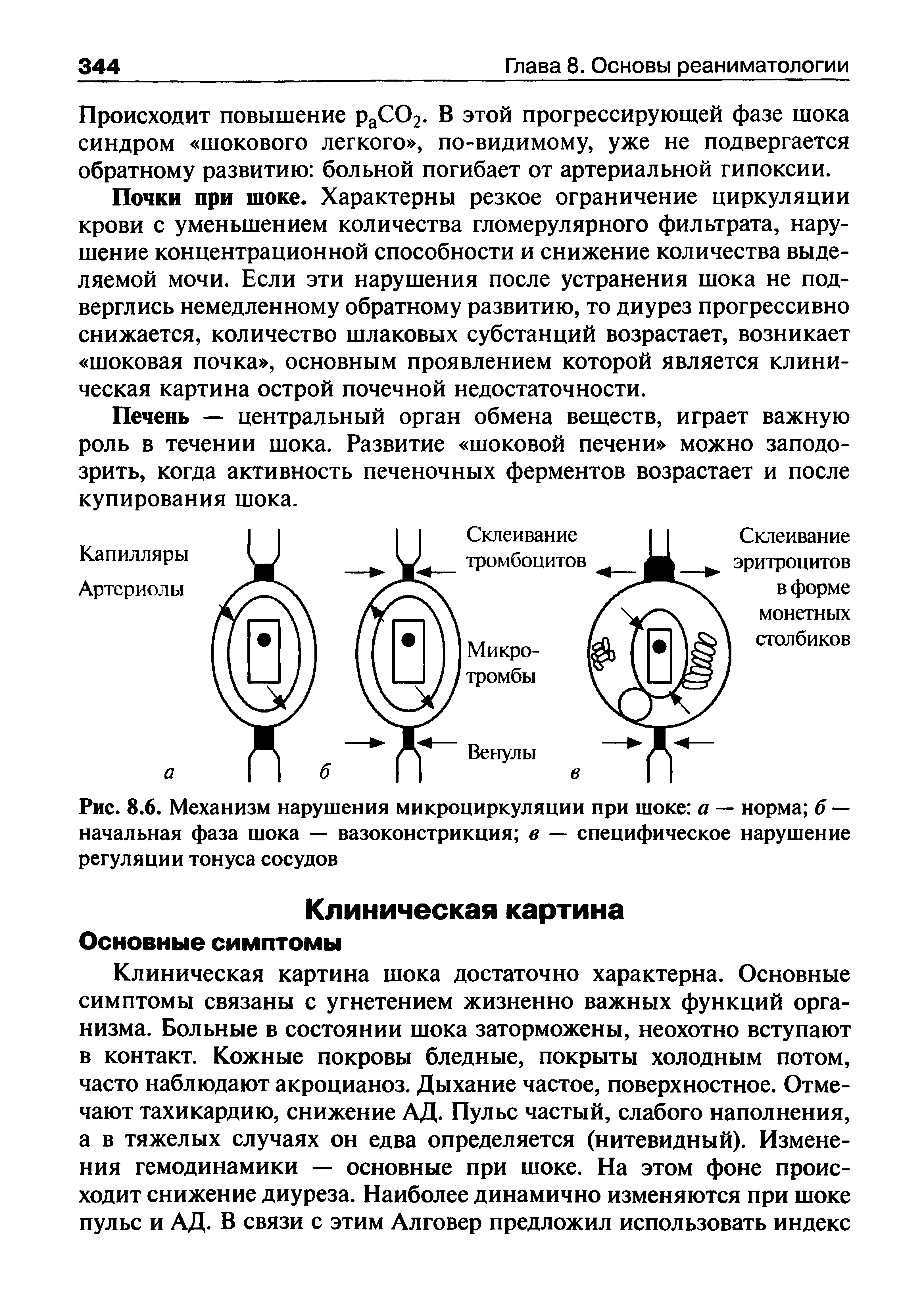 Рис. 8.6. Механизм нарушения микроциркуляции при шоке а — норма б — начальная фаза шока — вазоконстрикция в — специфическое нарушение регуляции тонуса сосудов...