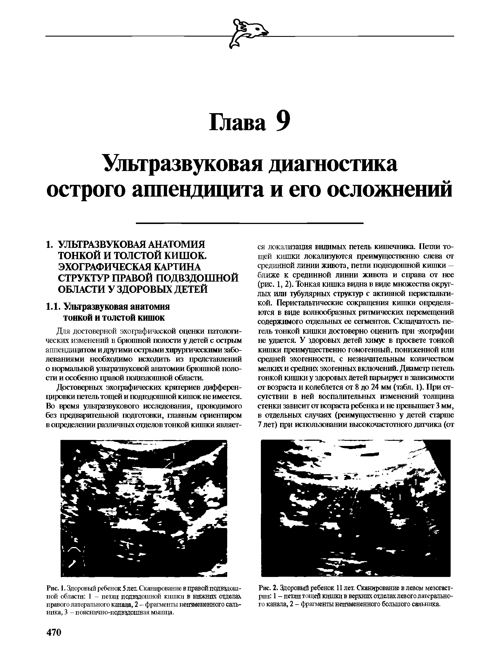 Рис. 1. Здоровый ребенок 5 лет. Сканирование в правой подвздошной области 1 - петли подвздошной кишки в нпжнпх отделах правого латерального канала, 2 - фрагменты неизмененного сальника, 3 - пояснично-подвздошная мышца-...