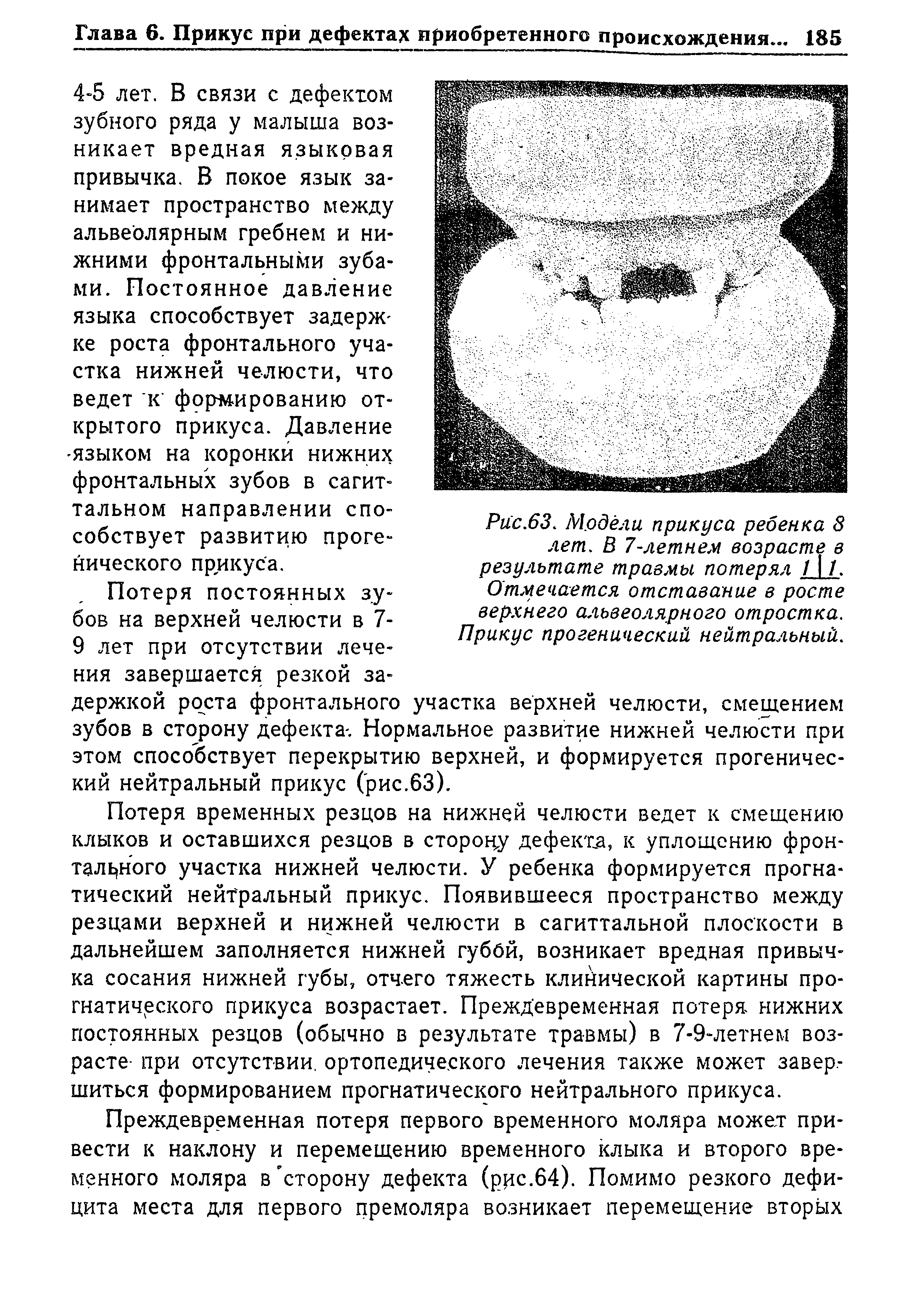 Рис.63. Модели прикуса ребенка 8 лет. В 7-летнем возрасте в результате травмы потерял /1 /. Отмечается отставание в росте верхнего альвеолярного отростка. Прикус прогенический нейтральный.