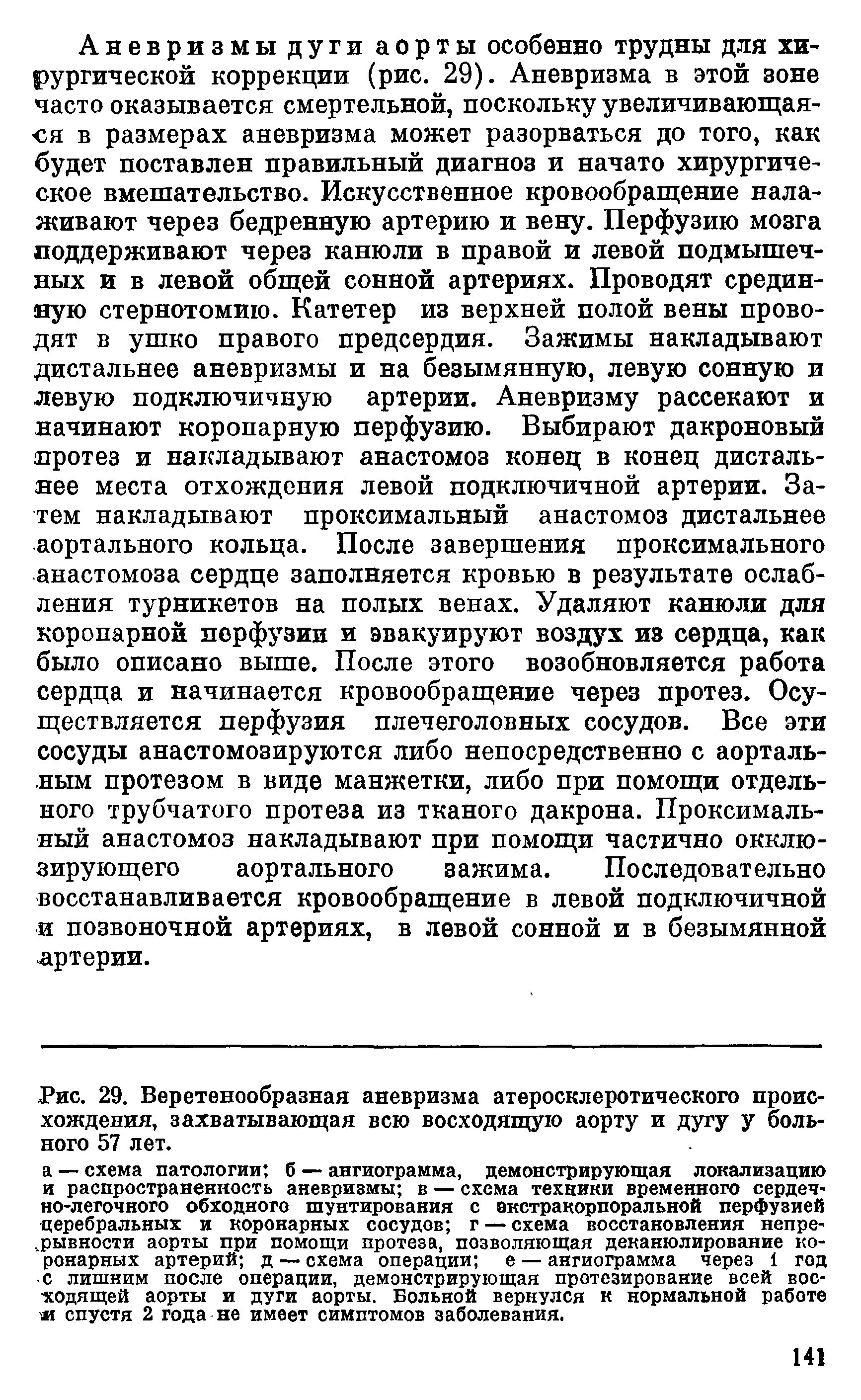 Рис. 29. Веретенообразная аневризма атеросклеротического происхождения, захватывающая всю восходящую аорту и дугу у больного 57 лет.