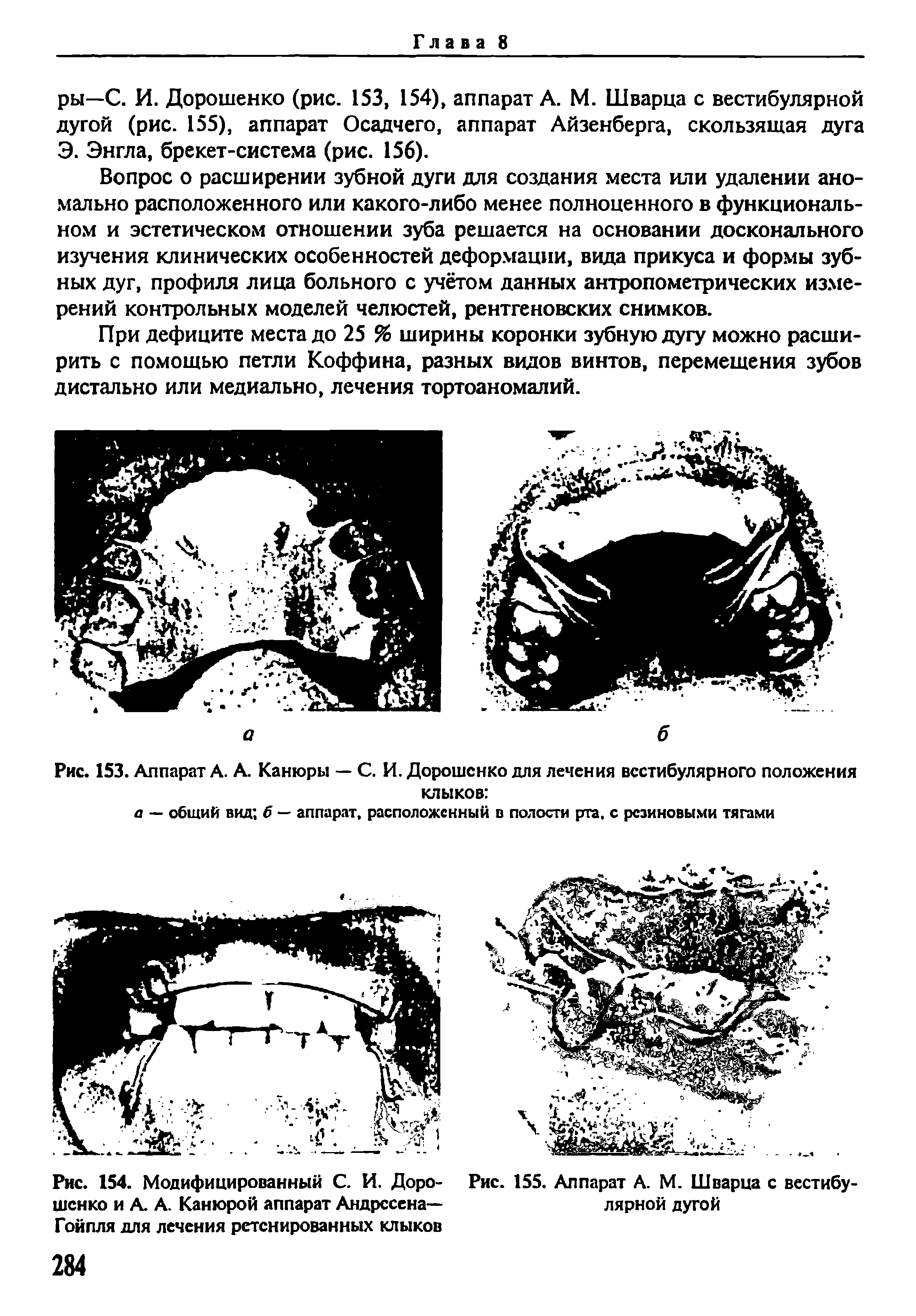 Рис. 154. Модифицированный С. И. Дорошенко и А. А. Канюрой аппарат Андресена— Гойпля для лечения рстснированных клыков...