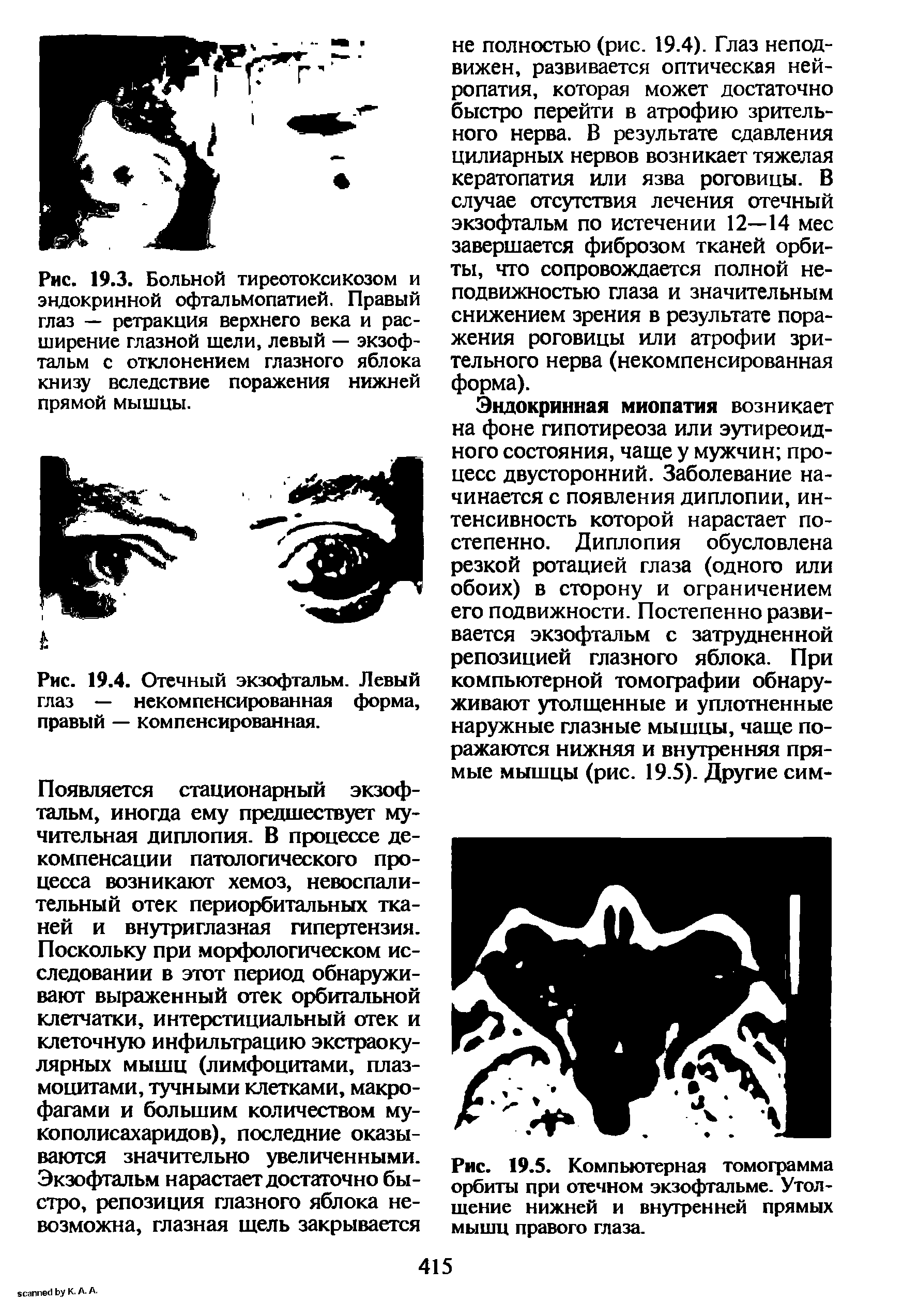 Рис. 19.5. Компьютерная томограмма орбиты при отечном экзофтальме. Утолщение нижней и внутренней прямых мышц правого глаза.