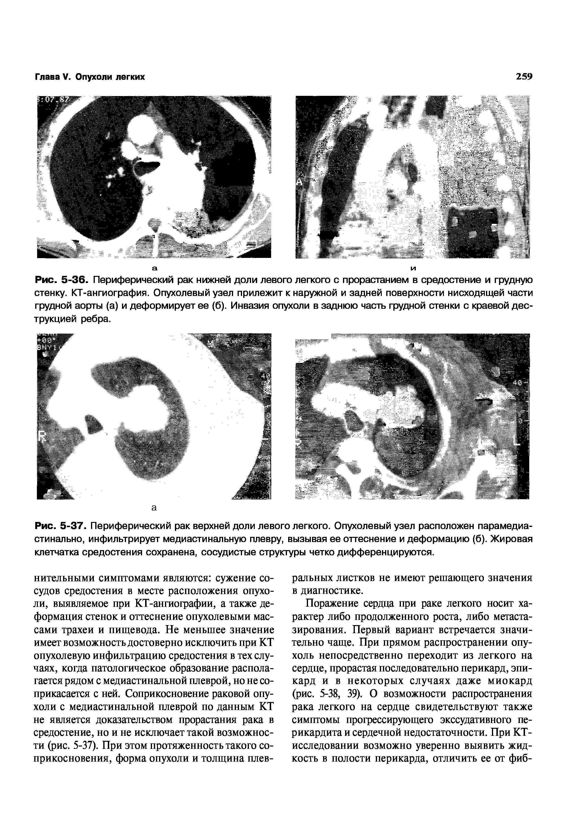 Рис. 5-36. Периферический рак нижней доли левого легкого с прорастанием в средостение и грудную стенку. КТ-ангиография. Опухолевый узел прилежит к наружной и задней поверхности нисходящей части грудной аорты (а) и деформирует ее (б). Инвазия опухоли в заднюю часть грудной стенки с краевой деструкцией ребра.