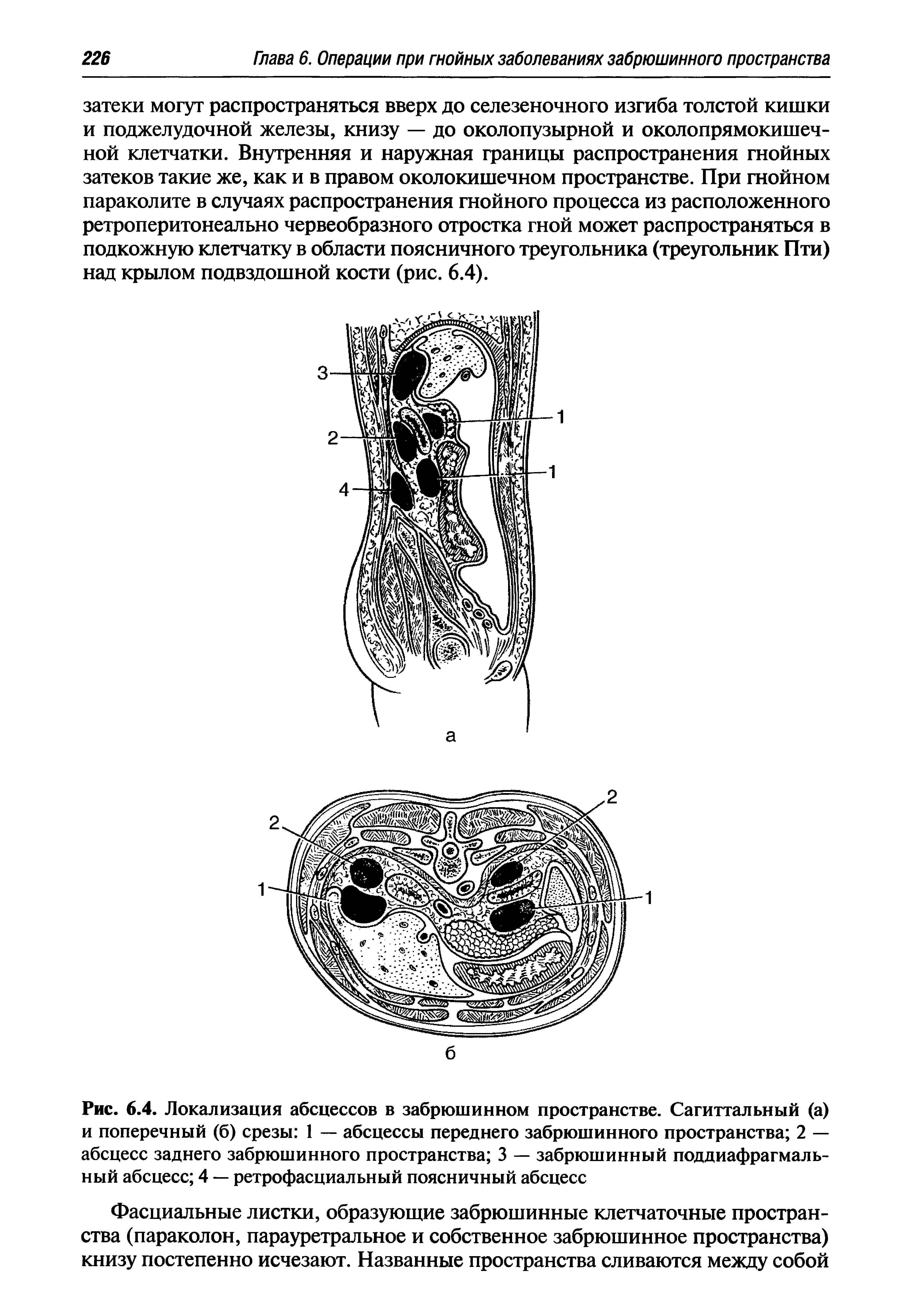 Рис. 6.4. Локализация абсцессов в забрюшинном пространстве. Сагиттальный (а) и поперечный (б) срезы 1 — абсцессы переднего забрюшинного пространства 2 — абсцесс заднего забрюшинного пространства 3 — забрюшинный поддиафрагмальный абсцесс 4 — ретрофасциальный поясничный абсцесс...