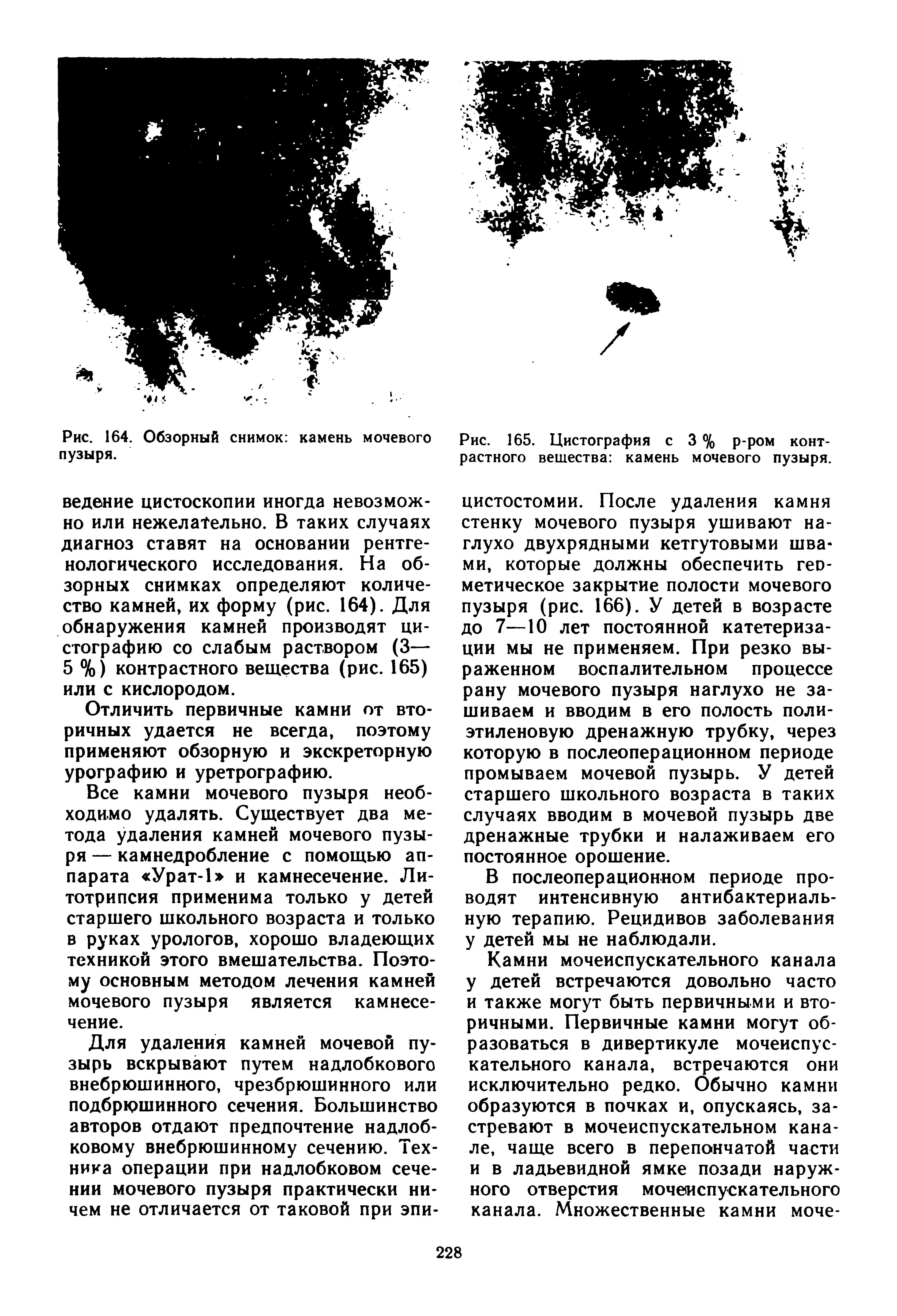 Рис. 165. Цистография с 3 % р-ром контрастного вещества камень мочевого пузыря.