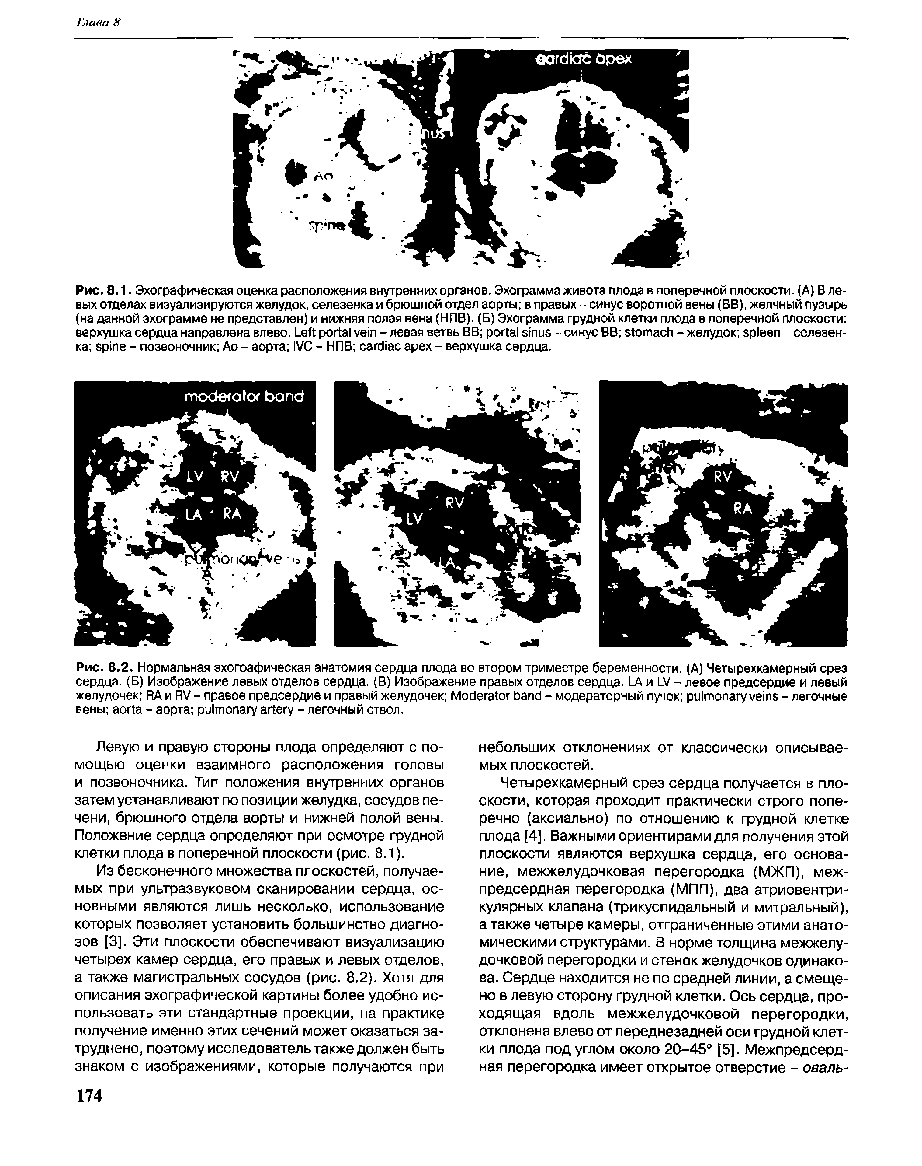 Рис. 8.2. Нормальная эхографическая анатомия сердца плода во втором триместре беременности. (А) Четырехкамерный срез сердца. (Б) Изображение левых отделов сердца. (В) Изображение правых отделов сердца. LA и LV - левое предсердие и левый желудочек RA и RV - правое предсердие и правый желудочек M - модераторный пучок - легочные вены - аорта - легочный ствол.