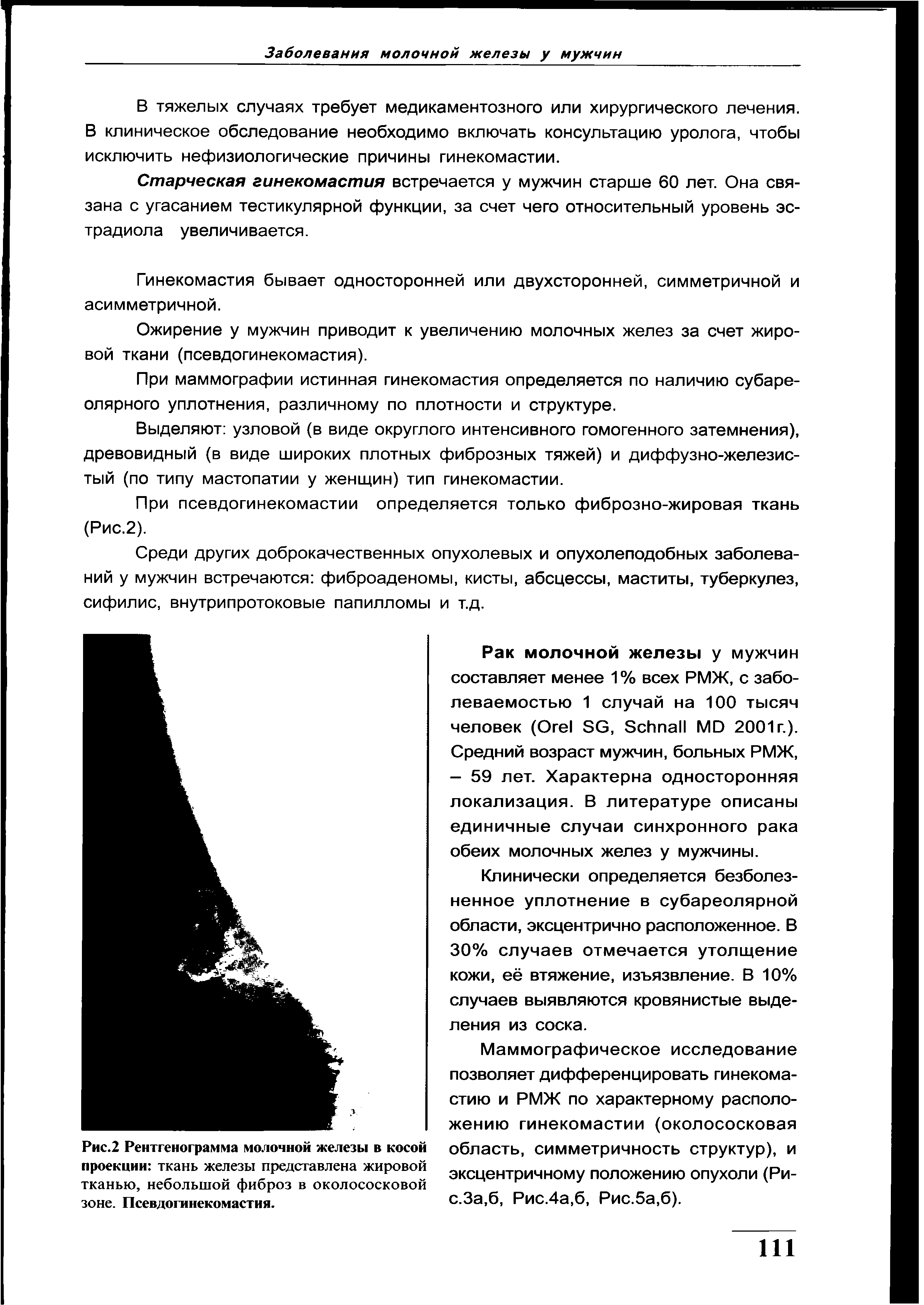 Рис.2 Рентгенограмма молочной железы в косой проекции ткань железы представлена жировой тканью, небольшой фиброз в околососковой зоне. Псевдогинекомастия.