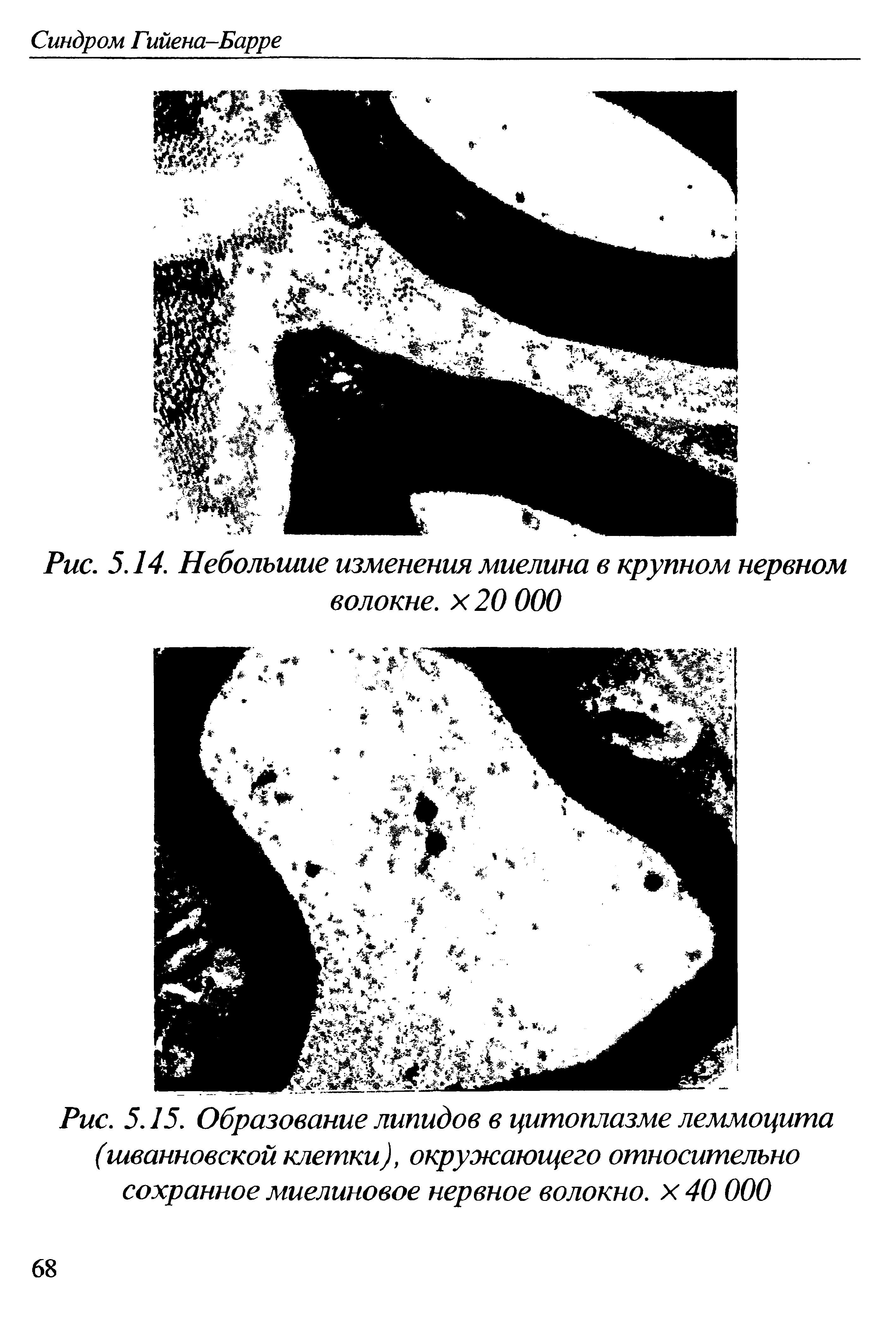 Рис. 5.15. Образование липидов в цитоплазме леммоцита (шванновской клетки), окружающего относительно сохранное миелиновое нервное волокно, х 40 000...