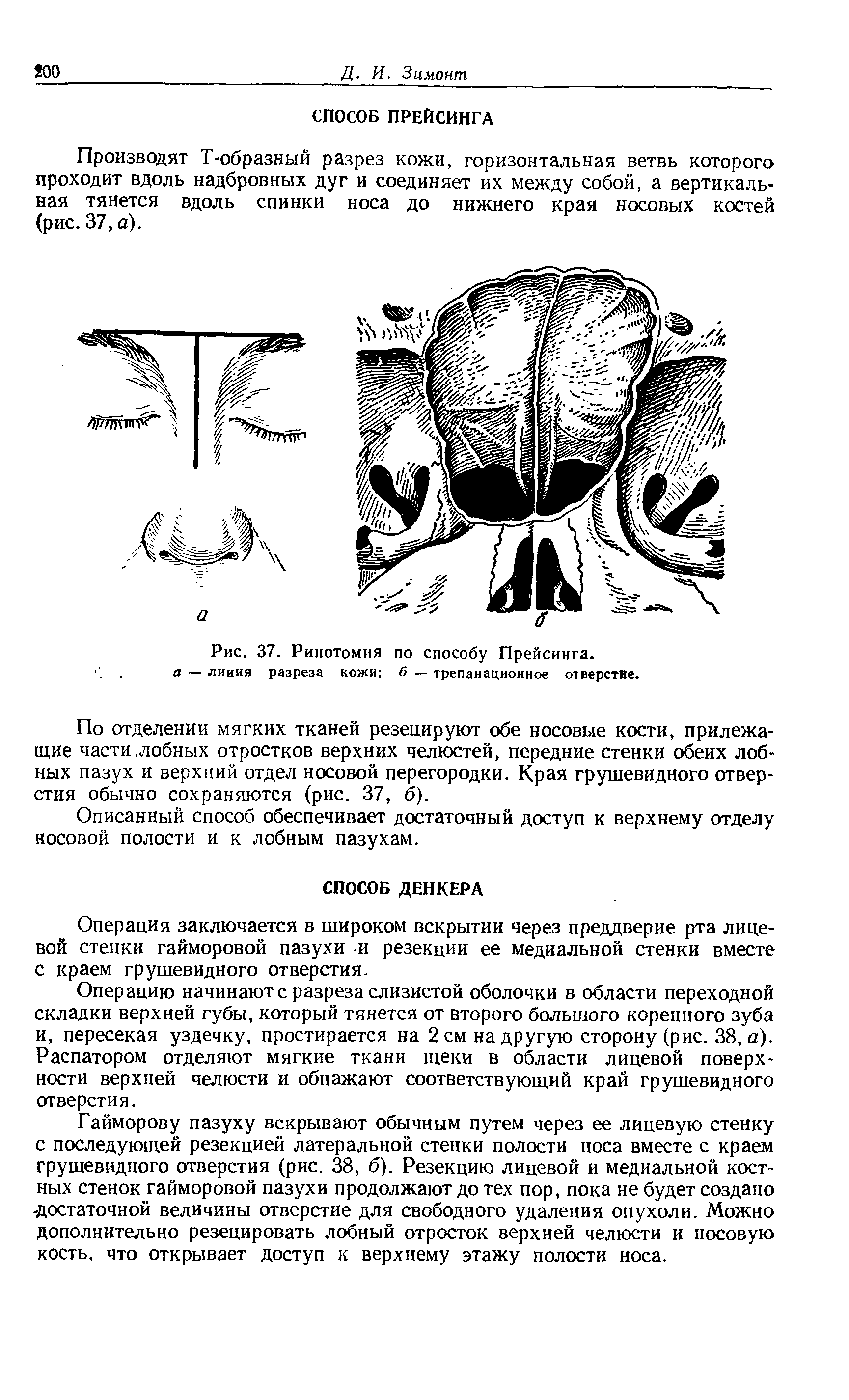 Рис. 37. Ринотомия по способу Прейсинга. а — линия разреза кожи б — трепанационное отверстие.