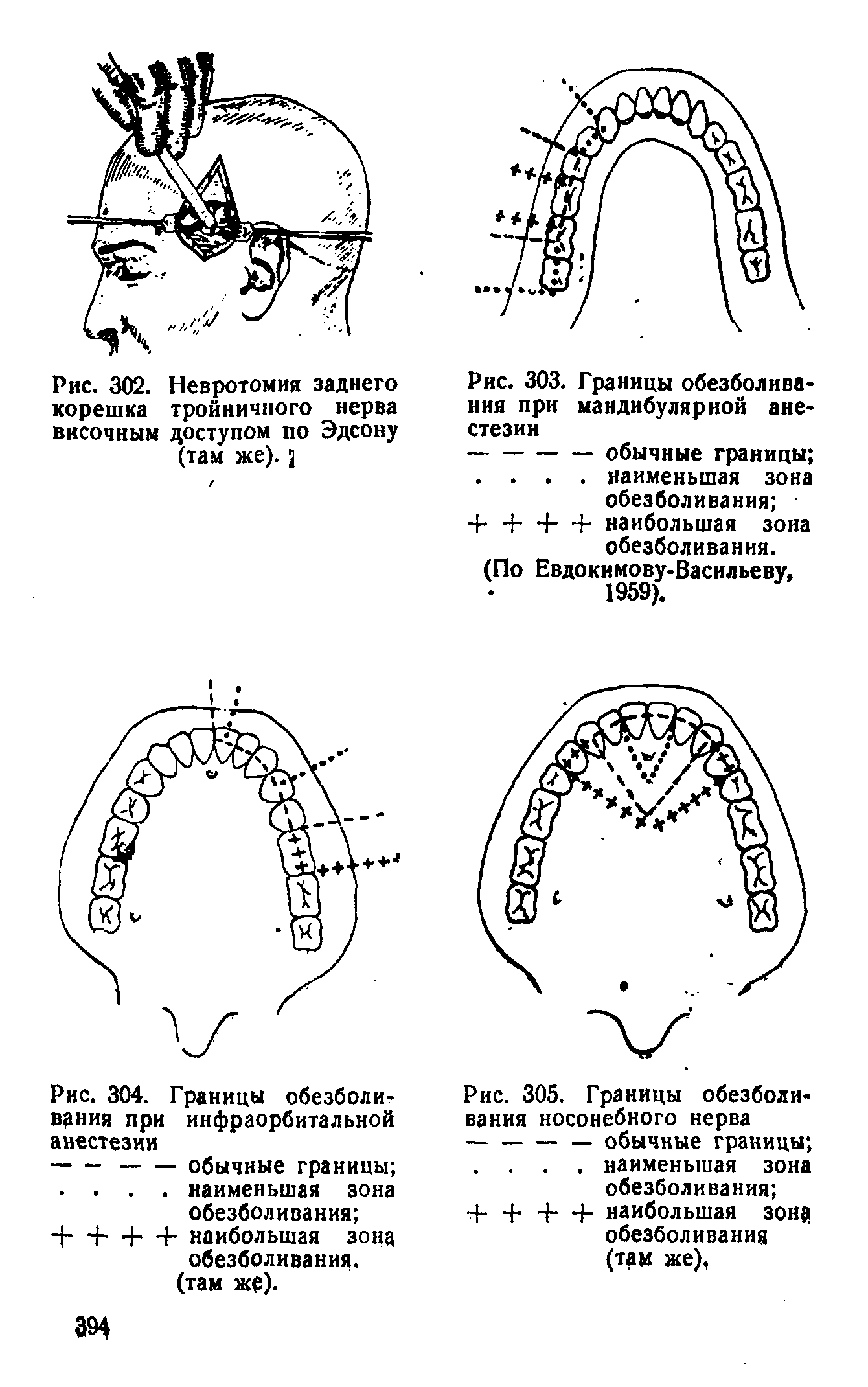 Рис. 305. Границы обезболивания носонебного нерва ----------обычные границы ...