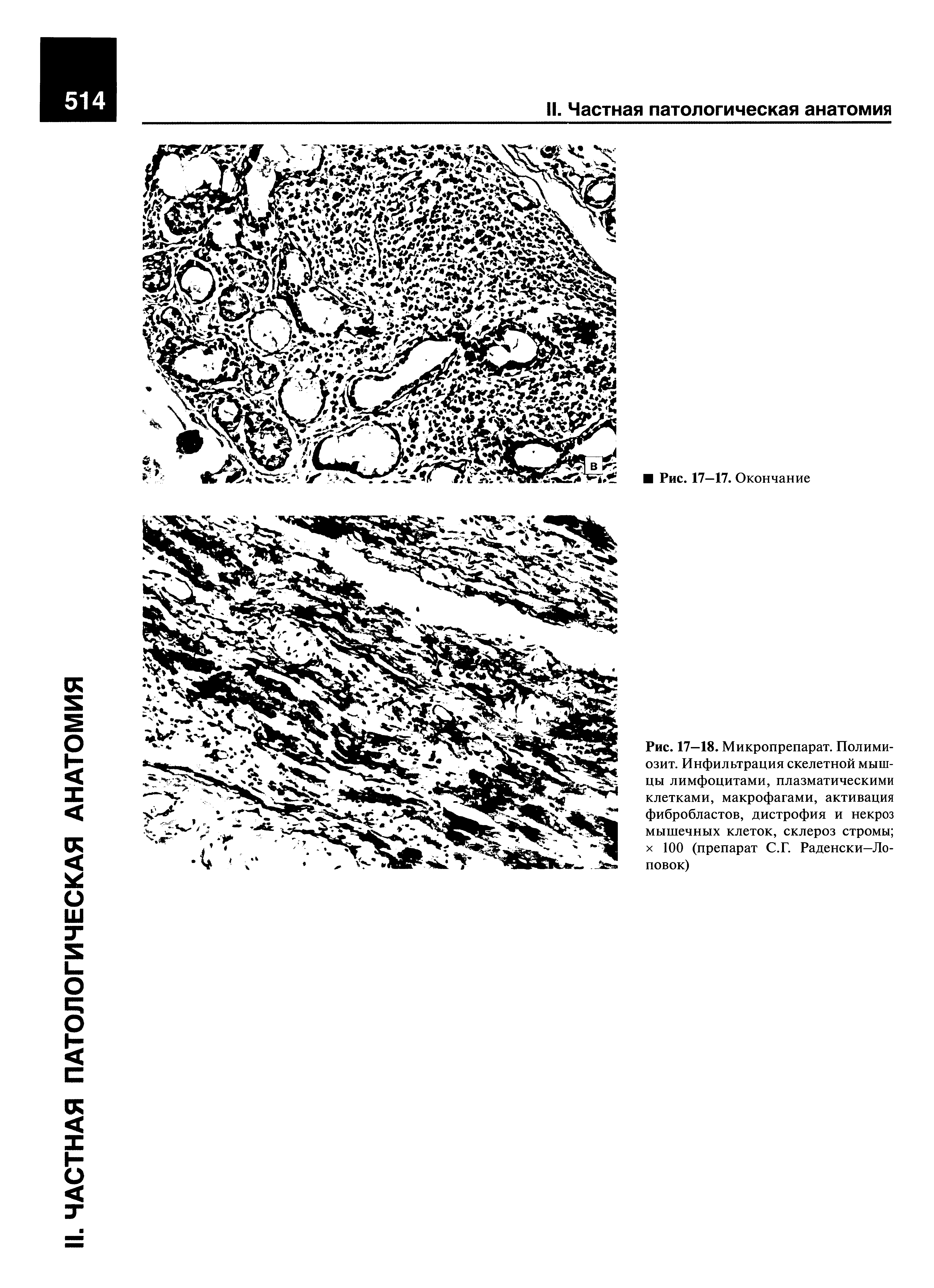 Рис. 17—18. Микропрепарат. Полимиозит. Инфильтрация скелетной мышцы лимфоцитами, плазматическими клетками, макрофагами, активация фибробластов, дистрофия и некроз мышечных клеток, склероз стромы х 100 (препарат С.Г. Раденски—Ло-повок)...