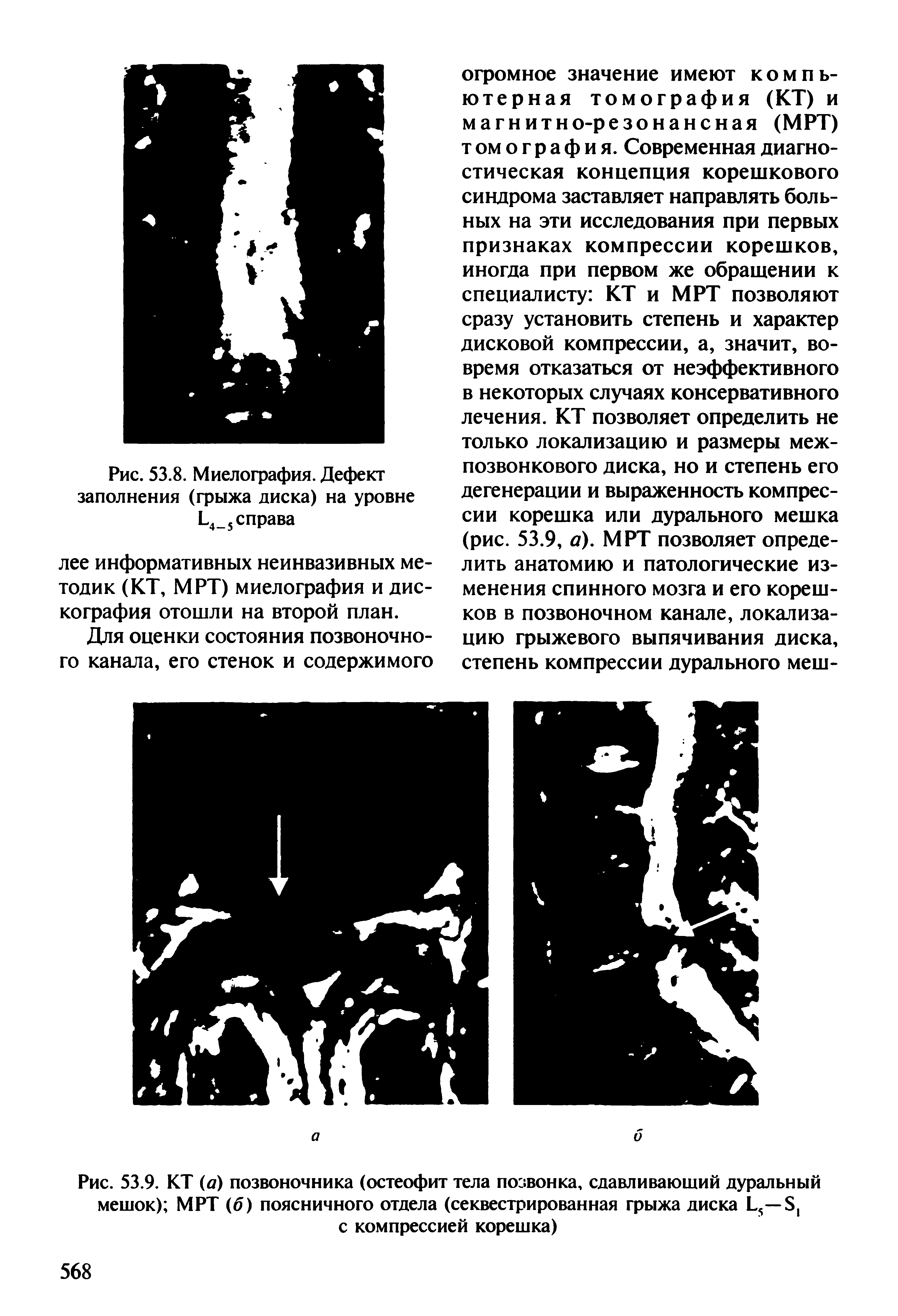 Рис. 53.9. КТ (а) позвоночника (остеофит тела позвонка, сдавливающий дуральный мешок) МРТ (б) поясничного отдела (секвестрированная грыжа диска L5— S с компрессией корешка)...