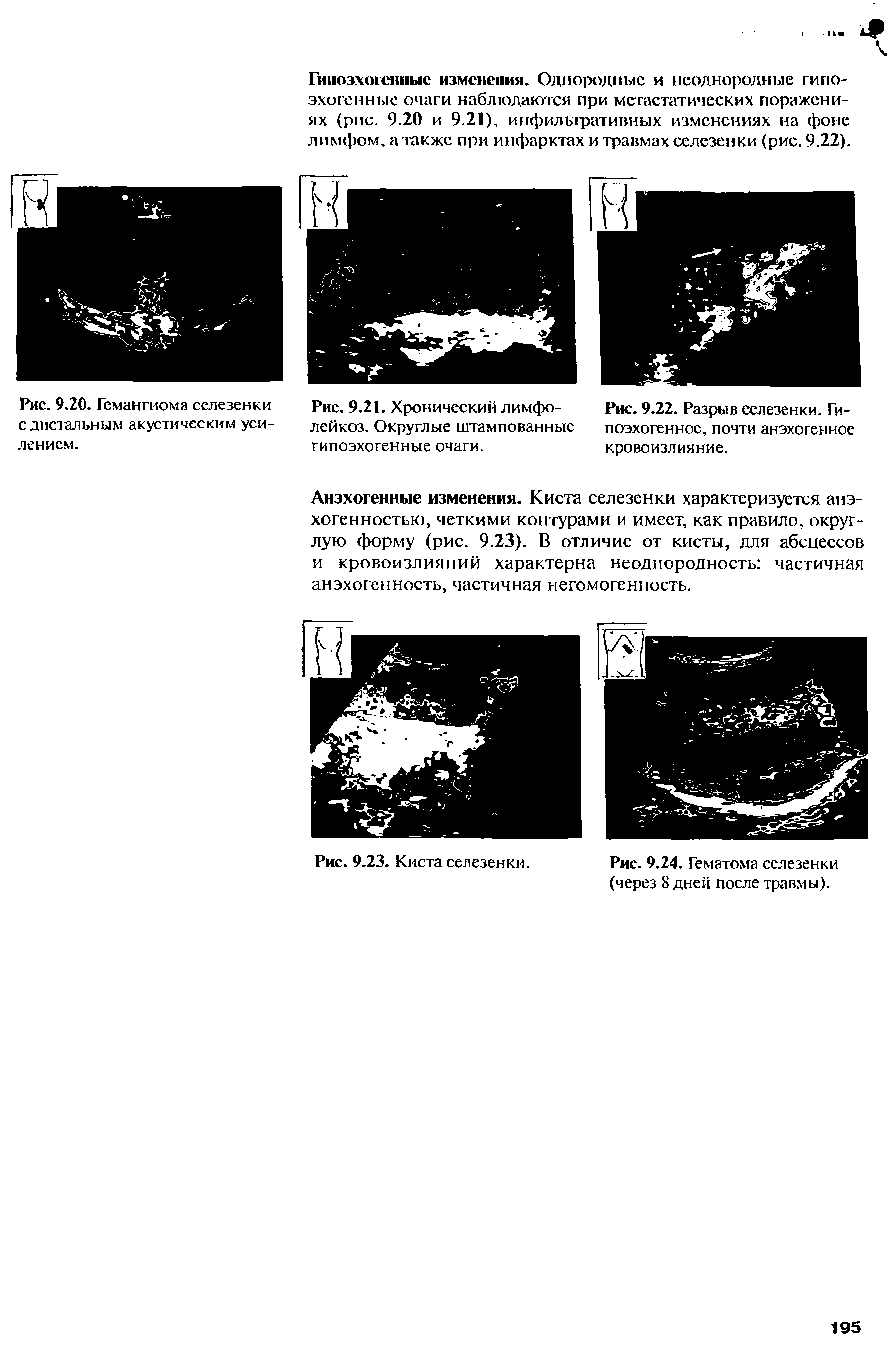 Рис. 9.24. Гематома селезенки (через 8 дней после травмы).