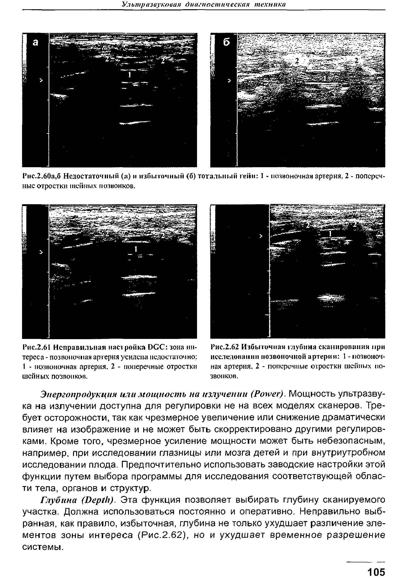 Рис.2.62 Избыточная глубина сканирования при исследовании позвоночной артерии 1 - позвоночная артерия. 2 - поперечные отростки шейных позвонков.