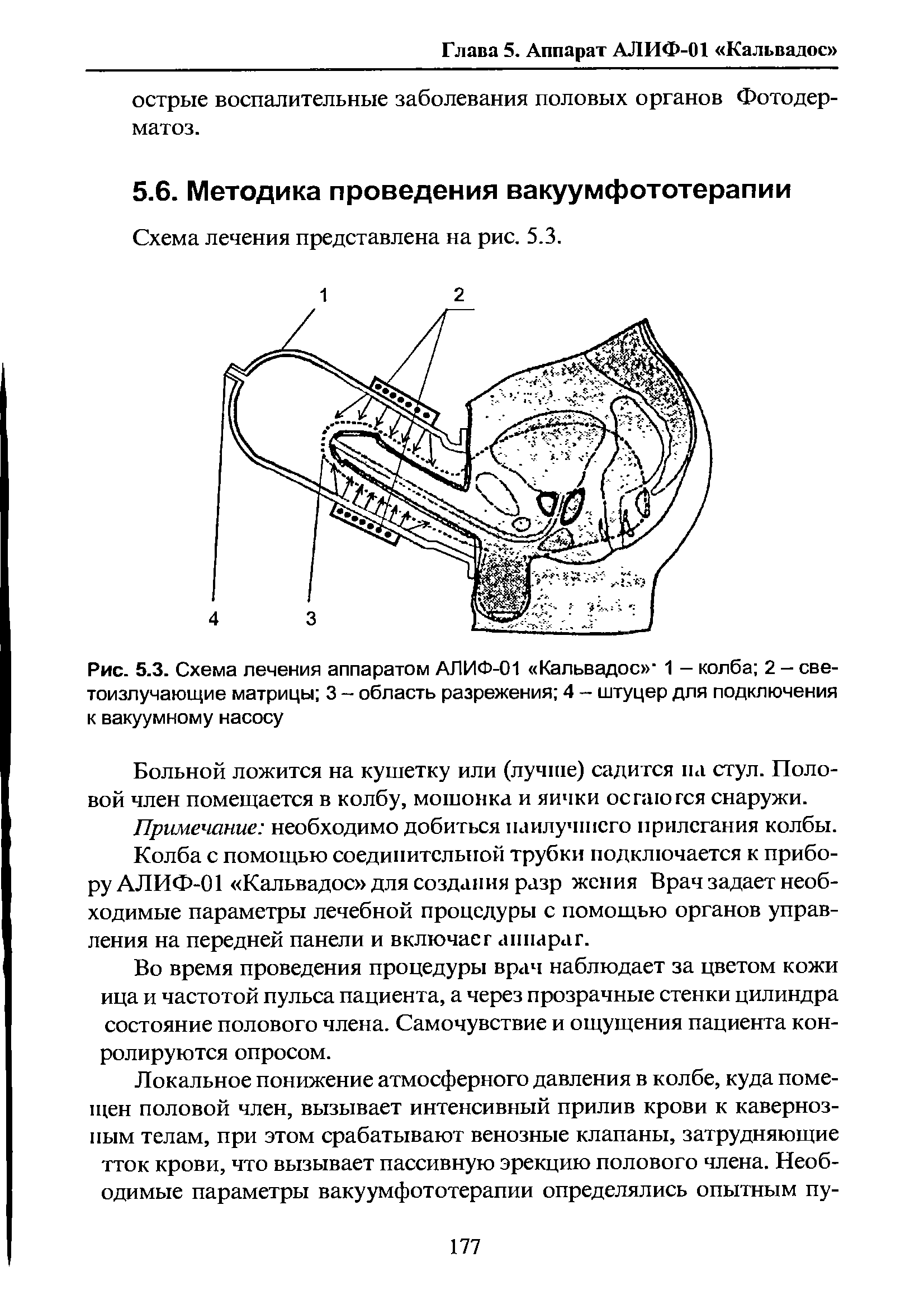 Рис. 5.3. Схема лечения аппаратом АЛИФ-01 Кальвадос 1 - колба 2 - светоизлучающие матрицы 3 - область разрежения 4 - штуцер для подключения к вакуумному насосу...