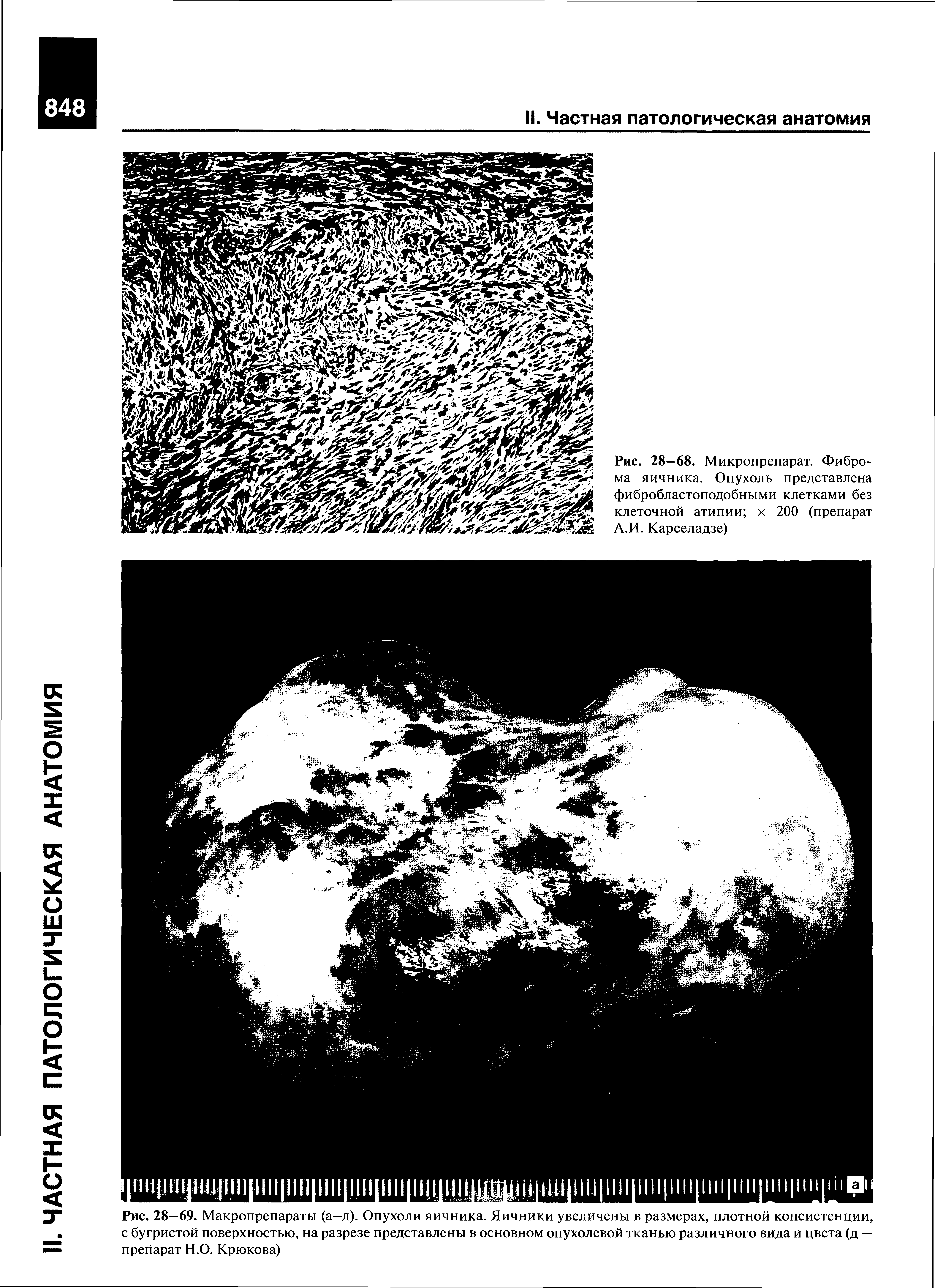 Рис. 28—69. Макропрепараты (а—д). Опухоли яичника. Яичники увеличены в размерах, плотной консистенции, с бугристой поверхностью, на разрезе представлены в основном опухолевой тканью различного вида и цвета (д — препарат Н.О. Крюкова)...