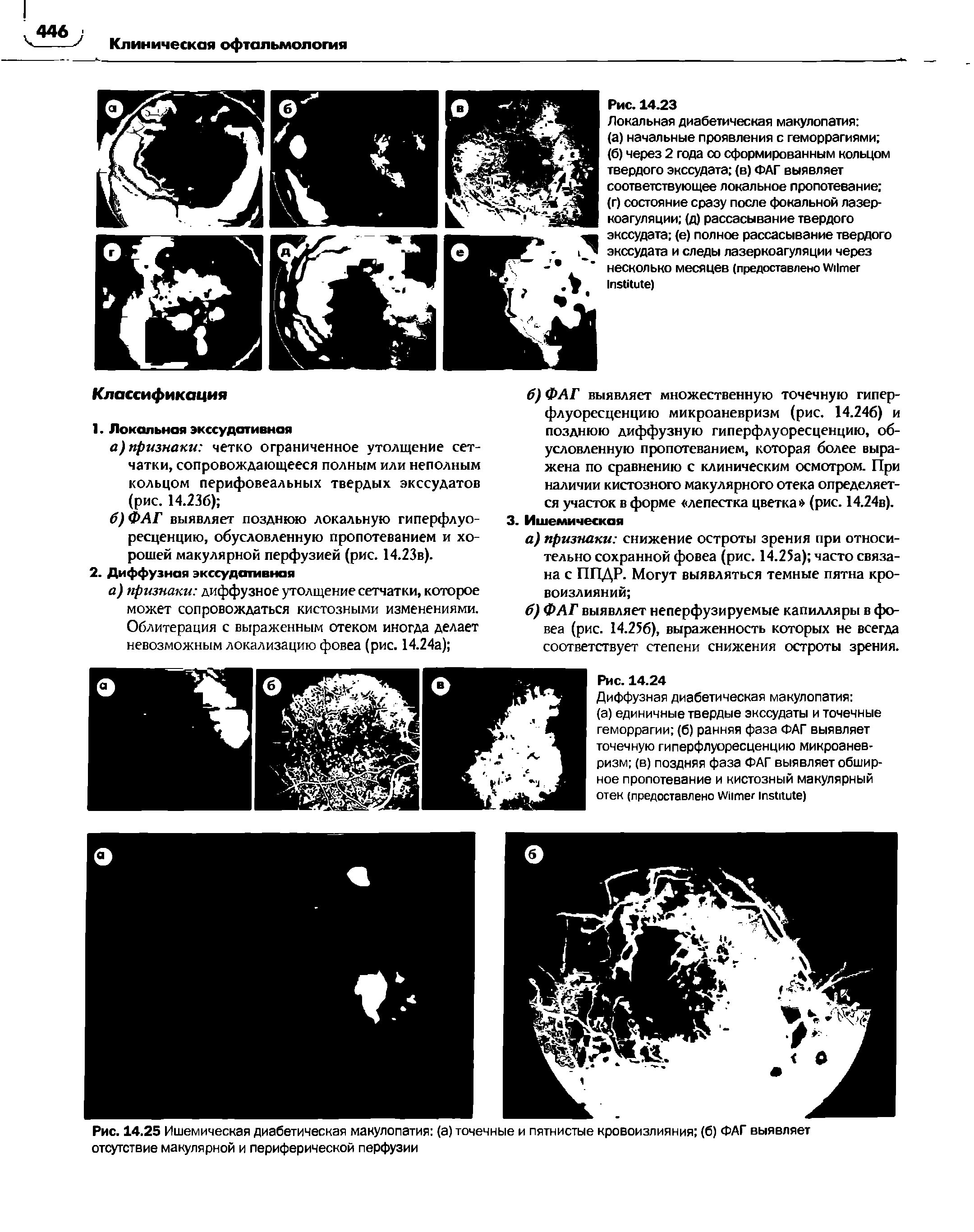 Рис. 14.25 Ишемическая диабетическая макулопатия (а) точечные и пятнистые кровоизлияния (б) ФАГ выявляет отсутствие макулярной и периферической перфузии...