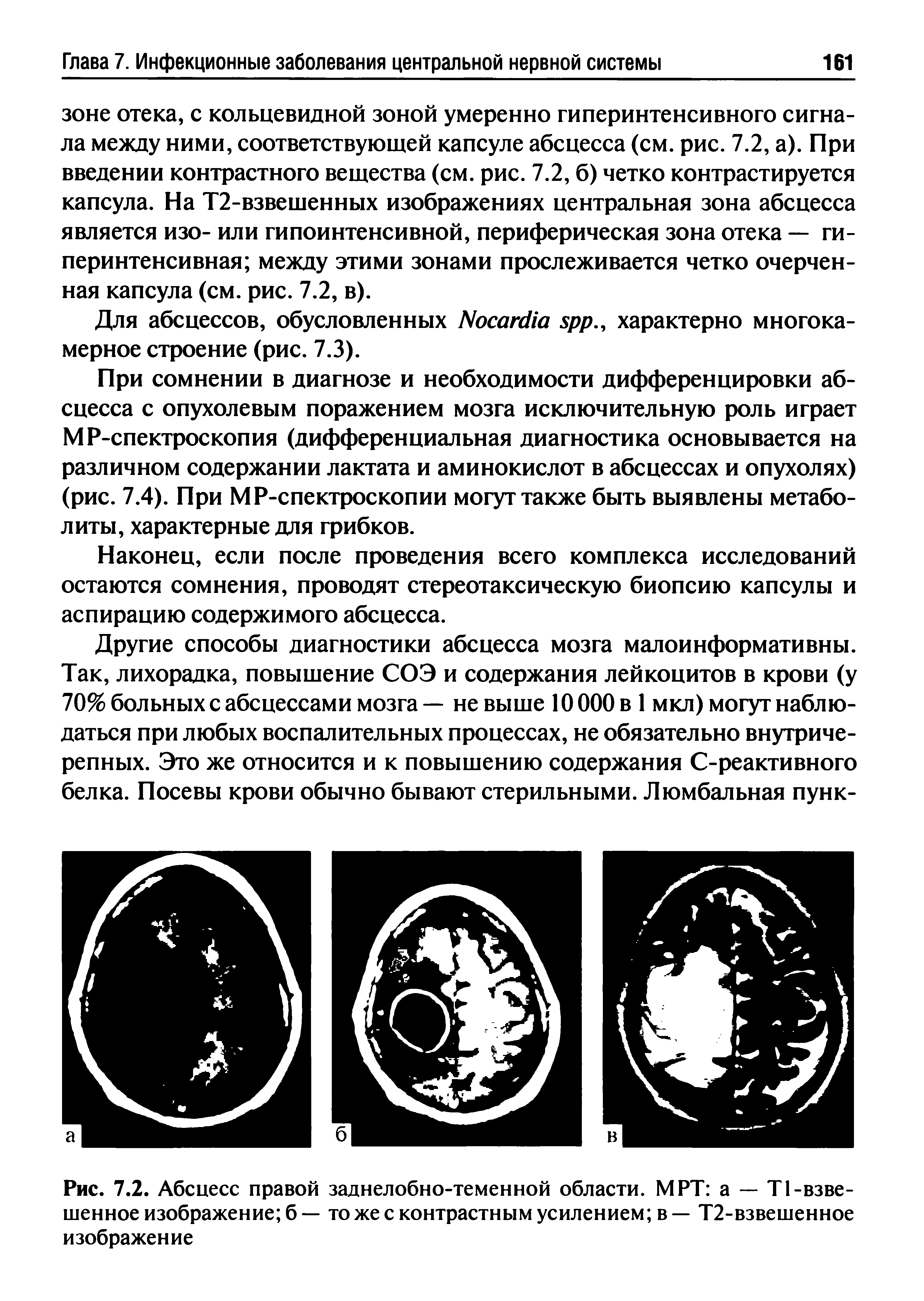 Рис. 7.2. Абсцесс правой заднелобно-теменной области. МРТ а — Т1-взве-шенное изображение б — то же с контрастным усилением в — Т2-взвешенное изображение...