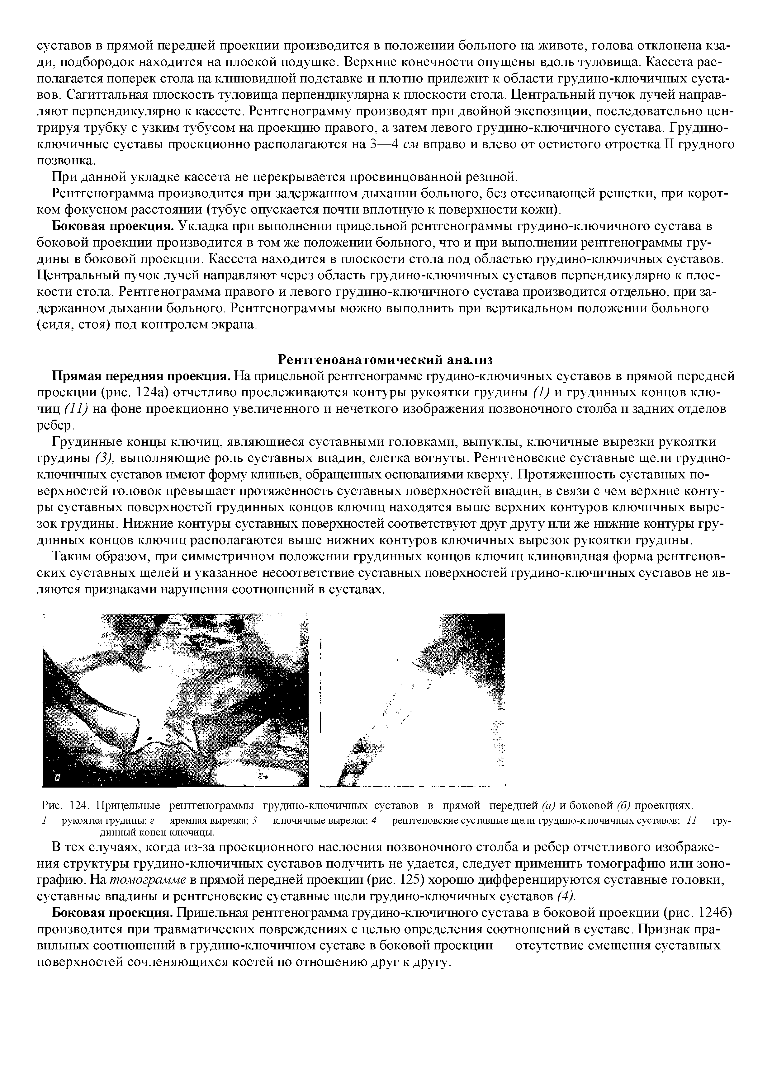 Рис. 124. Прицельные рентгенограммы грудино-ключичных суставов в прямой передней (а) и боковой (б) проекциях.