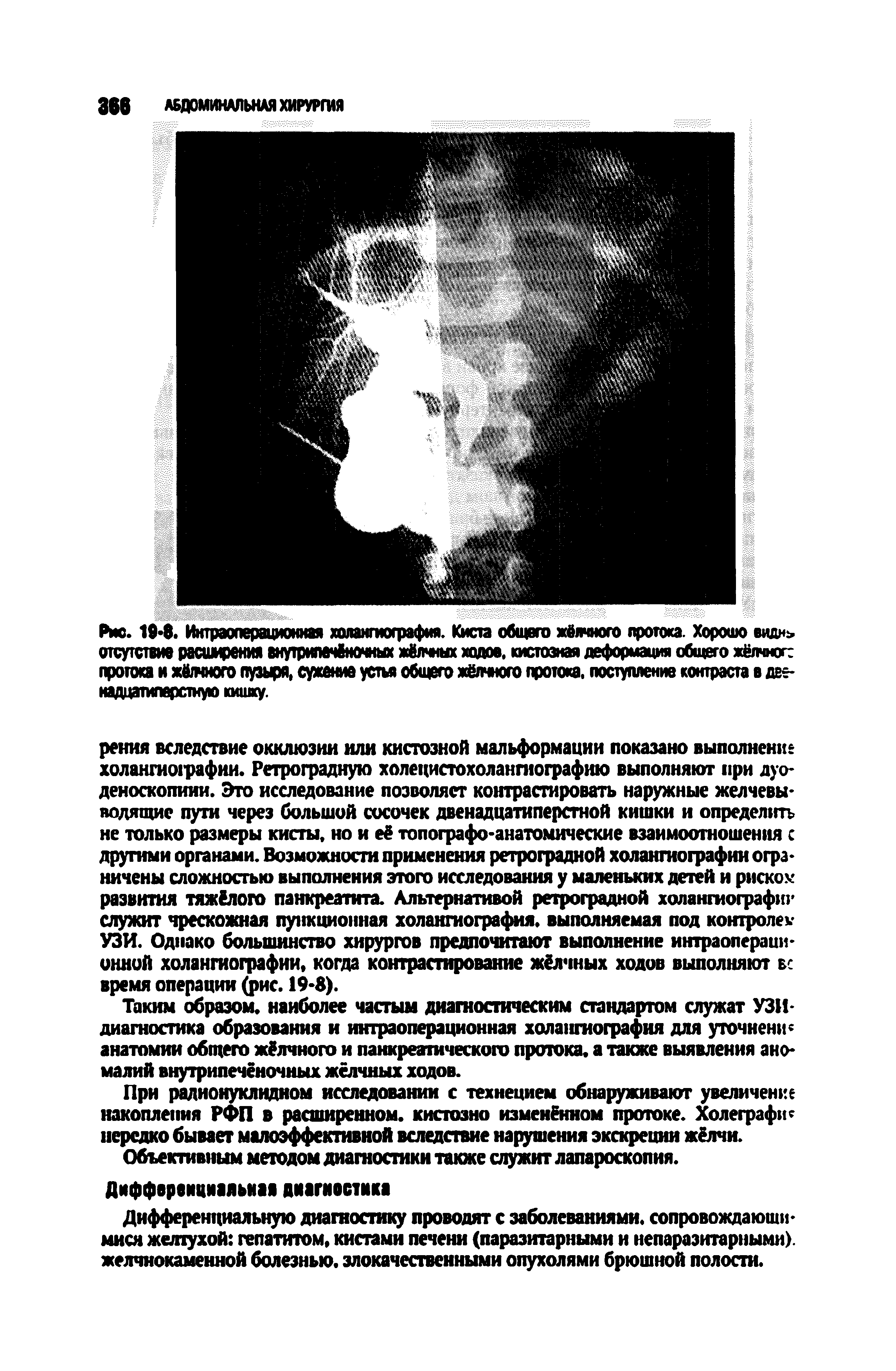 Рис. 19-8. Интраоперационная холангиография. Киста общего жёлчного протока. Хорошо еиднь. отсутствие расширения вяутримчбночных жёлчных ходов, кистозная деформация общего жёлчное протока и жёжиого пузыря, сужение устья общего жёлчного протока, поступление контраста в двенадцатиперстную кишку.