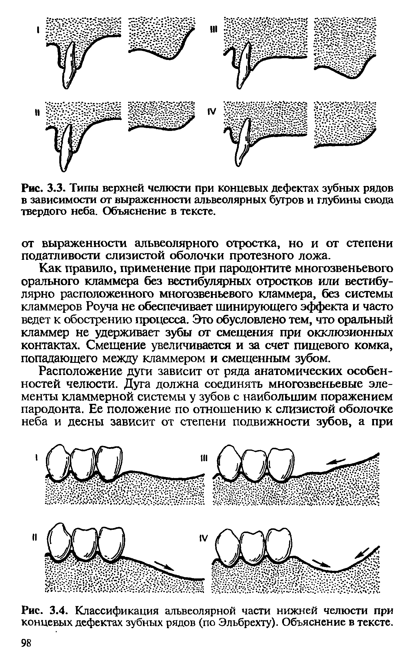 Рис. 3.4. Классификация альвеолярной части нижней челюсти при концевых дефектах зубных рядов (по Эльбрехту). Объяснение в тексте.