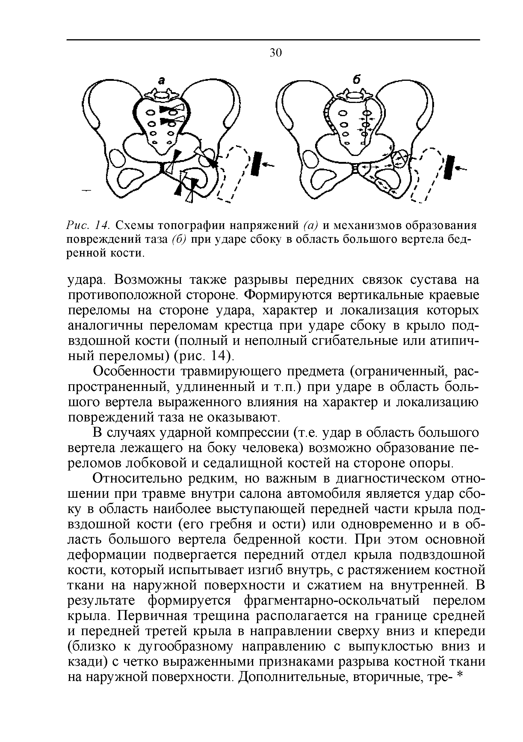 Рис. 14. Схемы топографии напряжений (а) и механизмов образования повреждений таза (б) при ударе сбоку в область большого вертела бедренной кости.