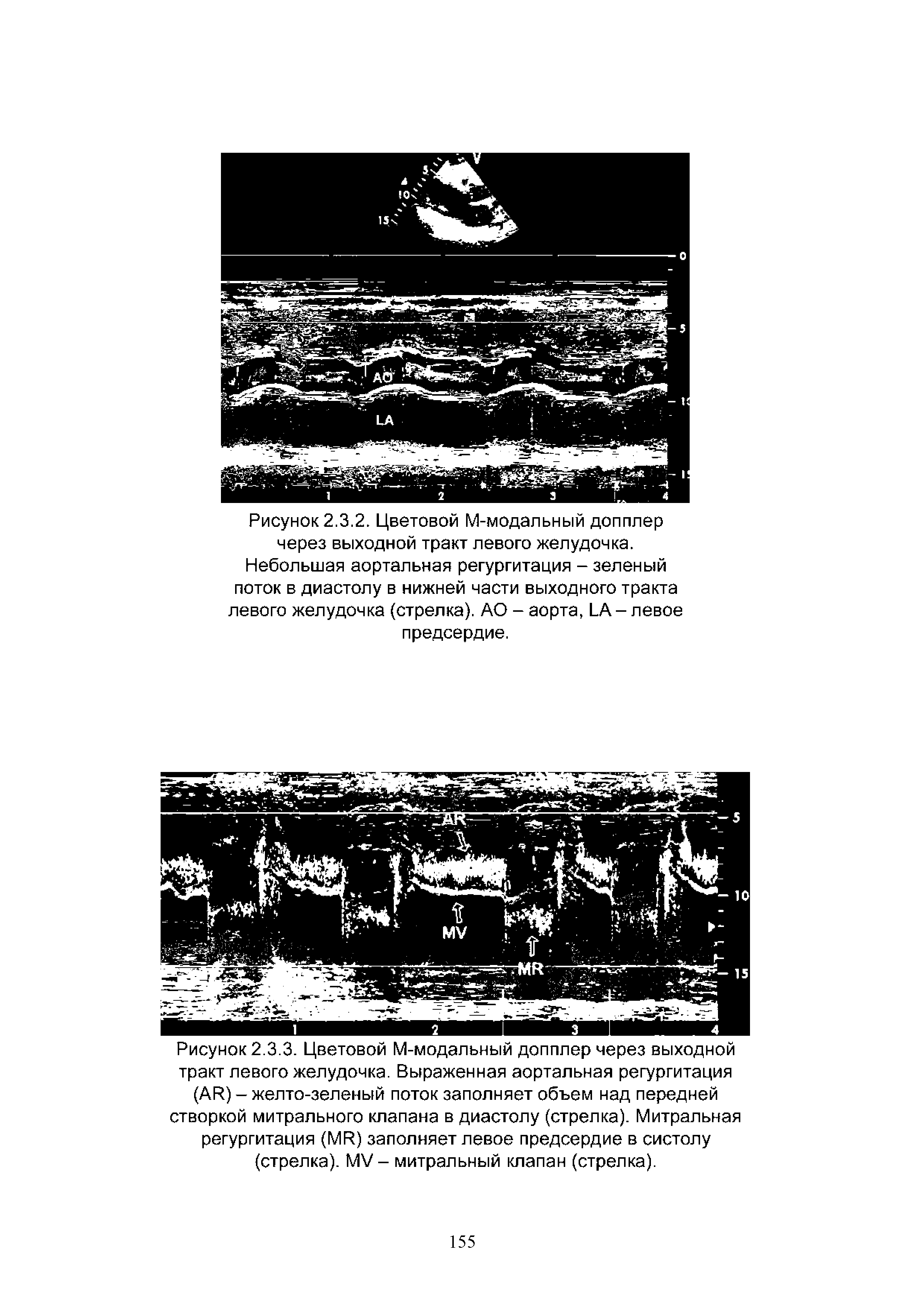 Рисунок 2.3.3. Цветовой М-модальный допплер через выходной тракт левого желудочка. Выраженная аортальная регургитация (АР) - желто-зеленый поток заполняет объем над передней створкой митрального клапана в диастолу (стрелка). Митральная регургитация (МР) заполняет левое предсердие в систолу (стрелка). М /- митральный клапан (стрелка).