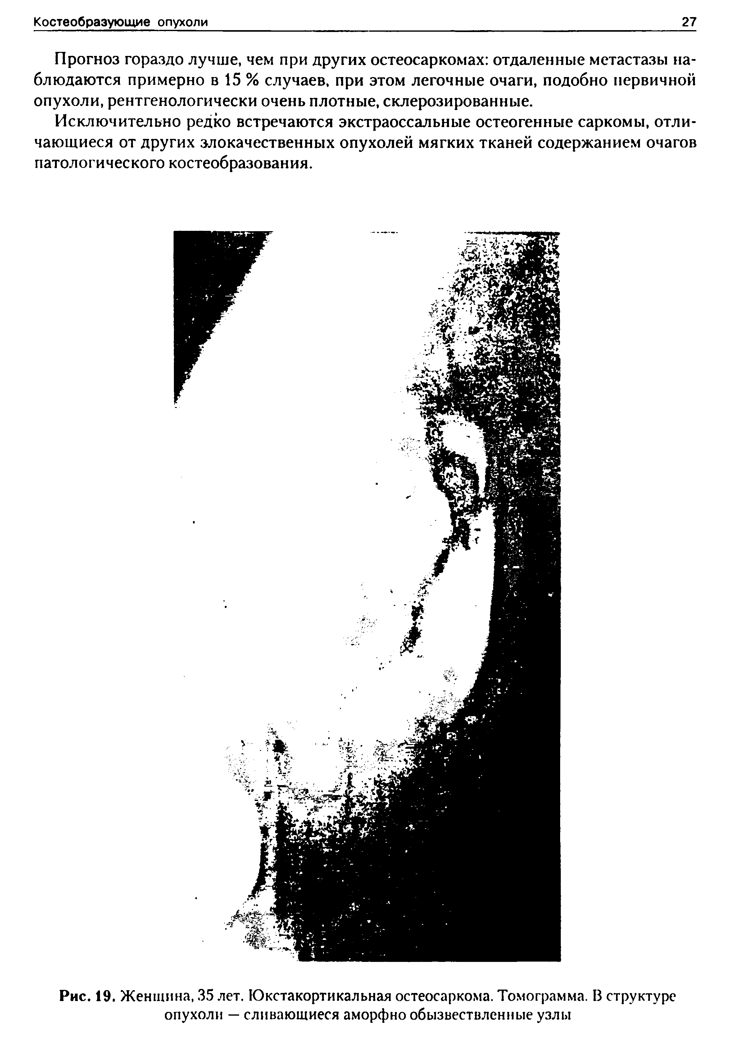 Рис. 19. Женщина, 35 лет. Юкстакортикальная остеосаркома. Томограмма. В структуре опухоли — сливающиеся аморфно обызвествленные узлы...