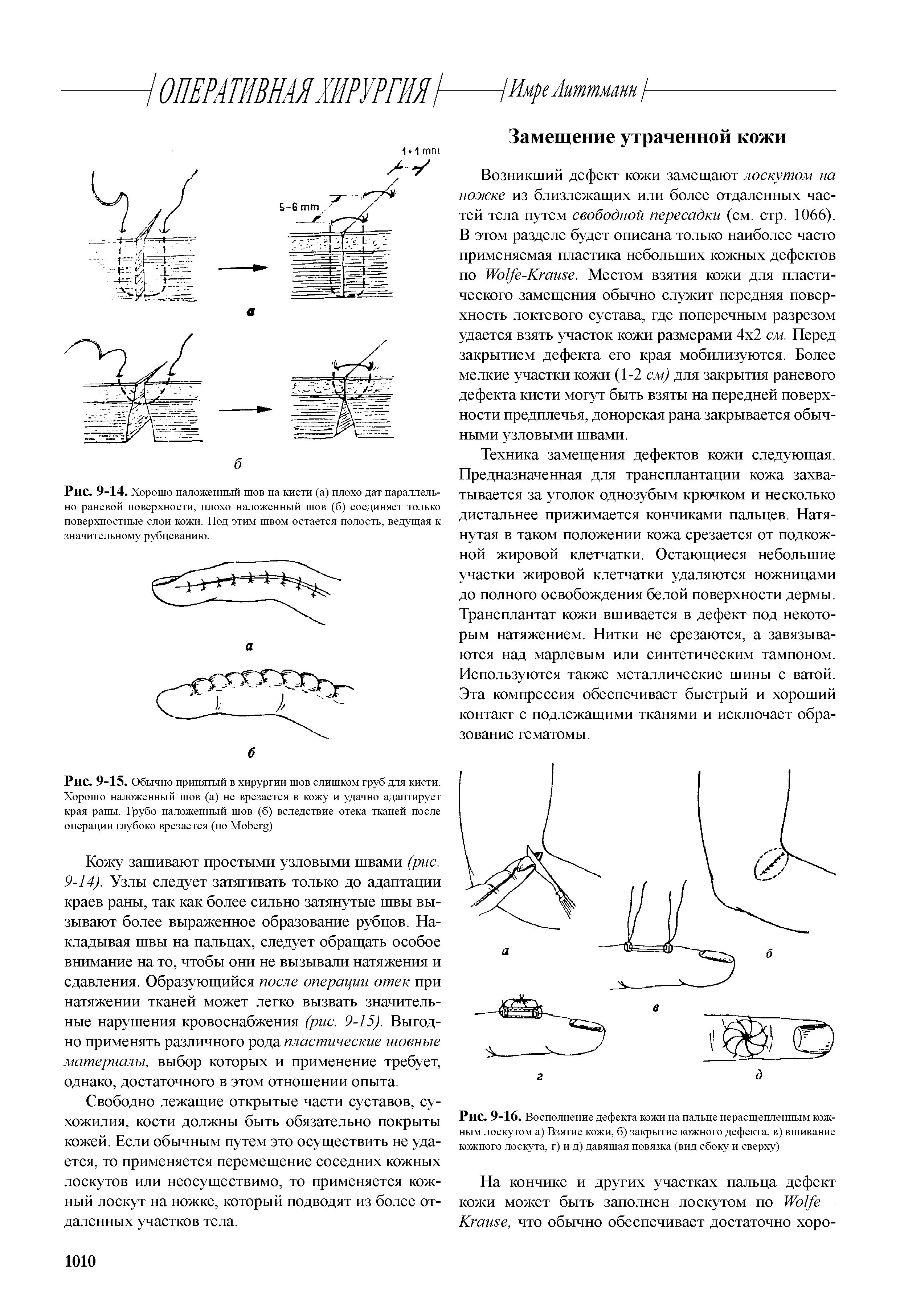 Рис. 9-16. Восполнение дефекта кожи на пальце нерасщепленным кожным лоскутом а) Взятие кожи, б) закрытие кожного дефекта, в) вшивание кожного лоскута, г) и д) давящая повязка (вид сбоку и сверху)...