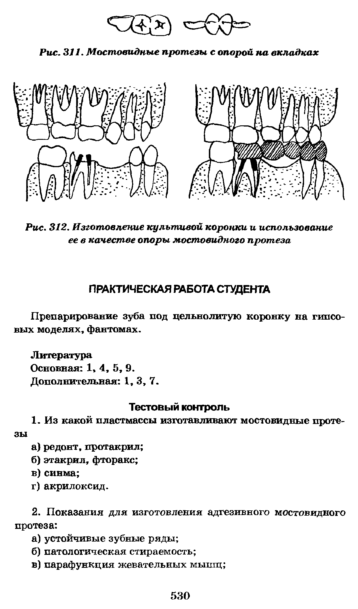 Рис. 312. Изготовление культовой коронки и использование ее в качестве опоры мостовидного протеза...