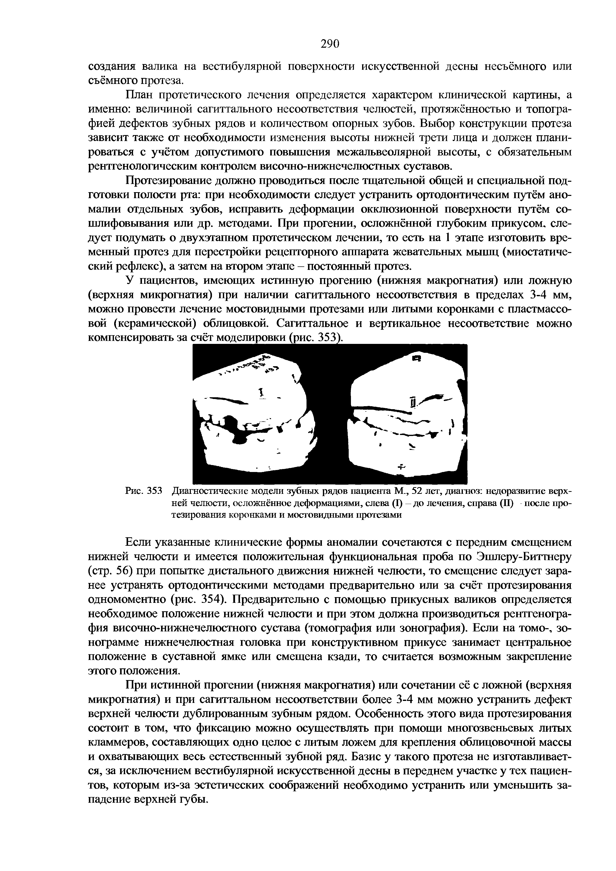 Рис. 353 Диагностические модели зубных рядов пациента М., 52 лет, диагноз недоразвитие верхней челюсти, осложнённое деформациями, слева (I) до лечения, справа (П) после протезирования коронками и мостовидными протезами...