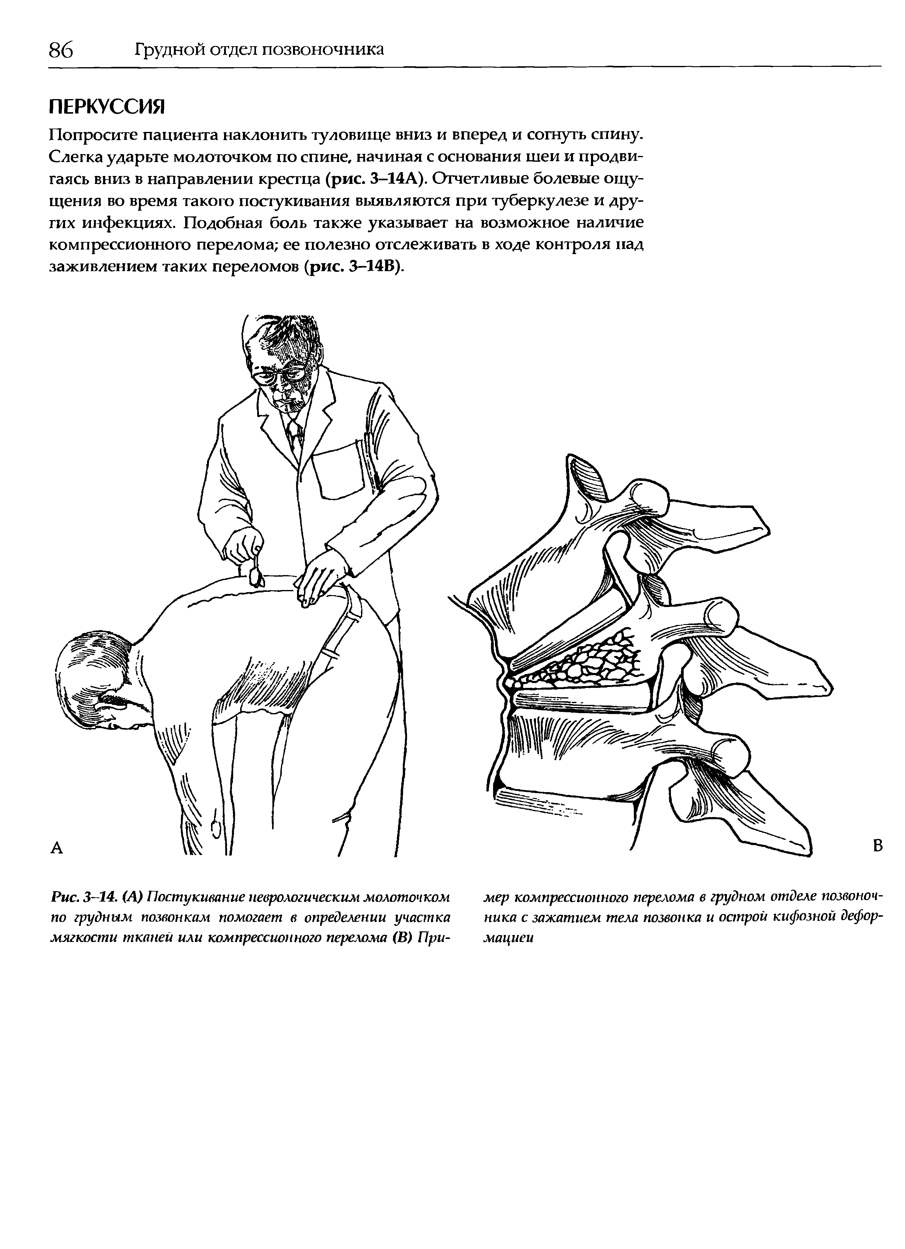 Рис. 3-14. (А) Постукивание неврологическим молоточком по грудным позвонкам помогает в определении участка мягкости тканей или компрессионного перелома (В) При-...