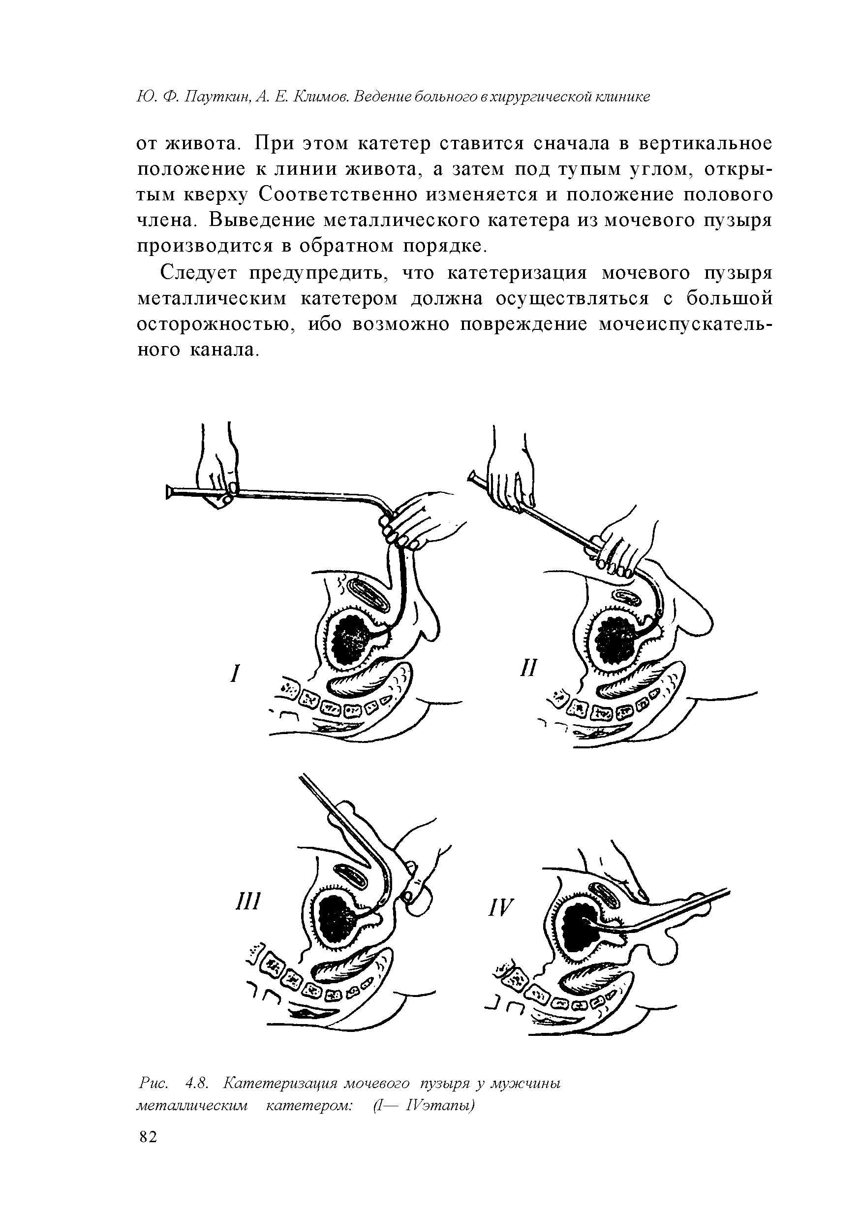 Рис. 4.8. Катетеризация мочевого пузыря у мужчины металлическим катетером (I— ГУэтапы)...