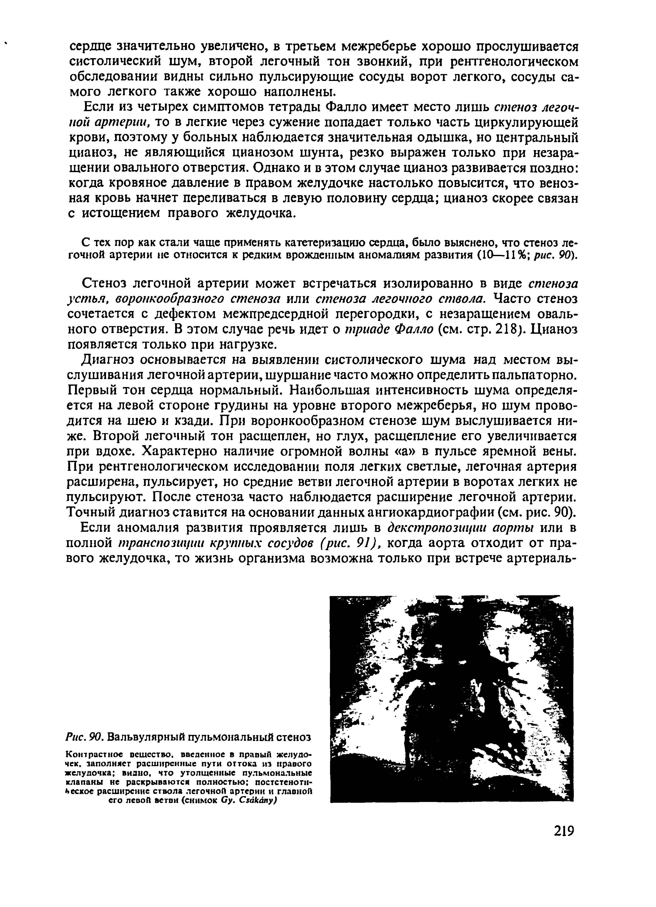 Рис. 90. Вальвулярный пульмональный стеноз Контрастное вещество. введенное в правый желудочек. заполняет расширенные пути оттока из правого желудочка видно, что утолщенные пульмональные клапаны не раскрываются полностью постстеноти-ьеское расширение ствола легочной артерии и главной его левой ветви (снимок Су, Сзакапу)...