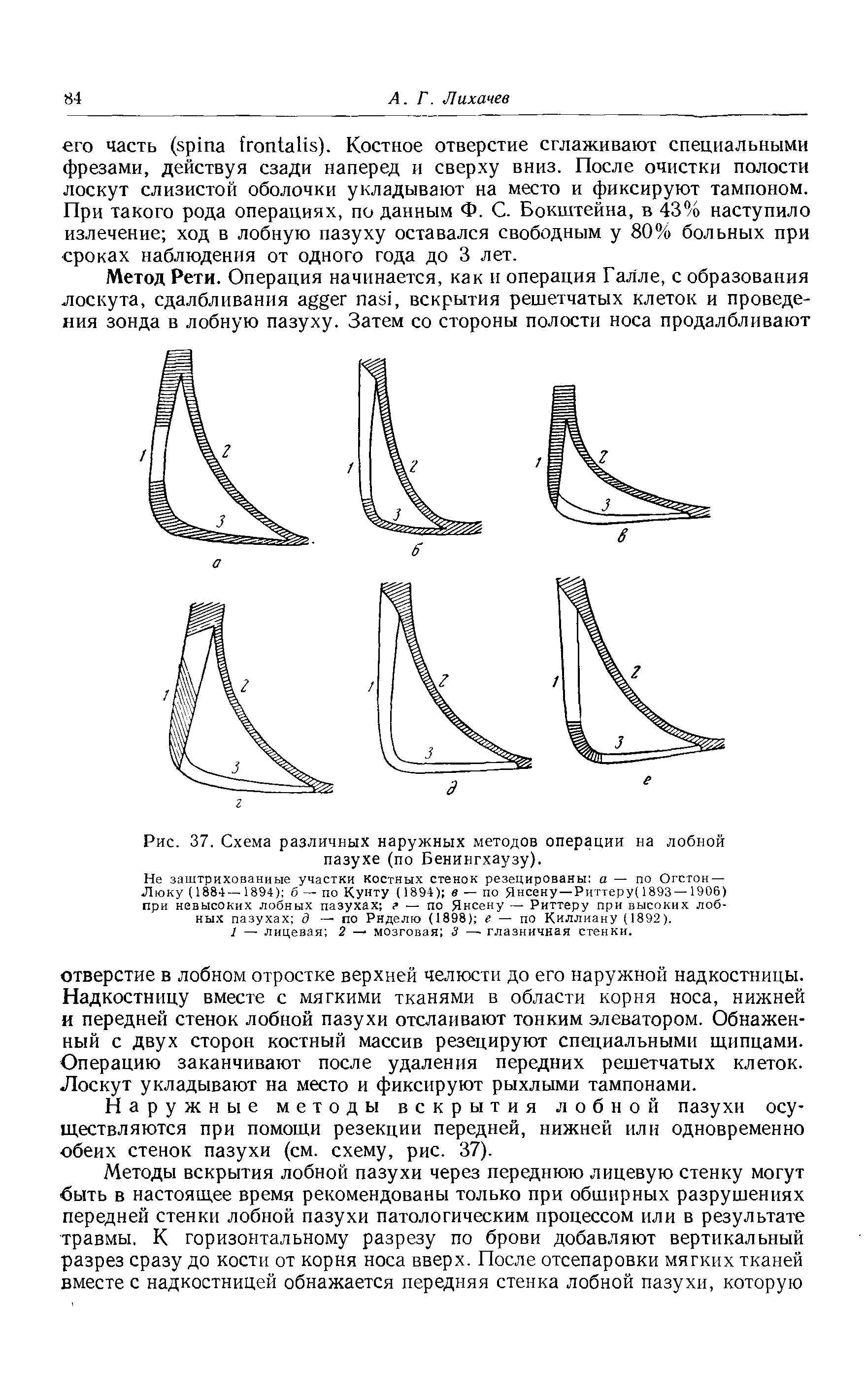 Рис. 37. Схема различных наружных методов операции на лобной пазухе (по Бенингхаузу).