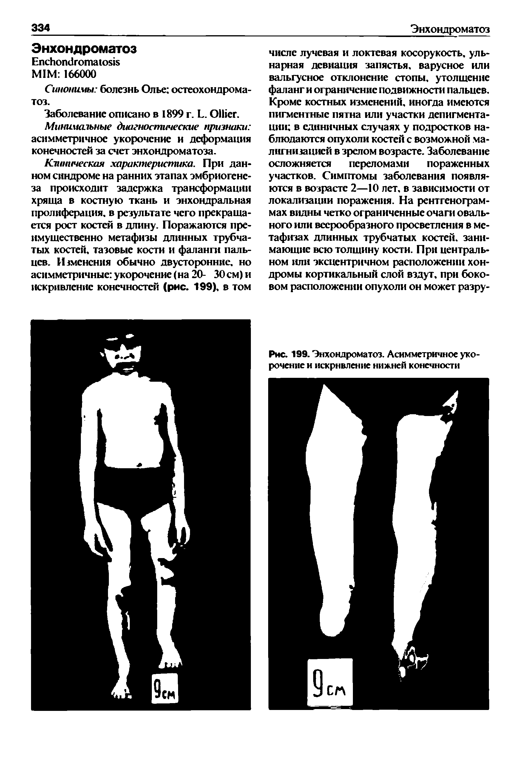 Рис. 199. Энхондроматоз. Асимметричное укорочение и искривление нижней конечности...