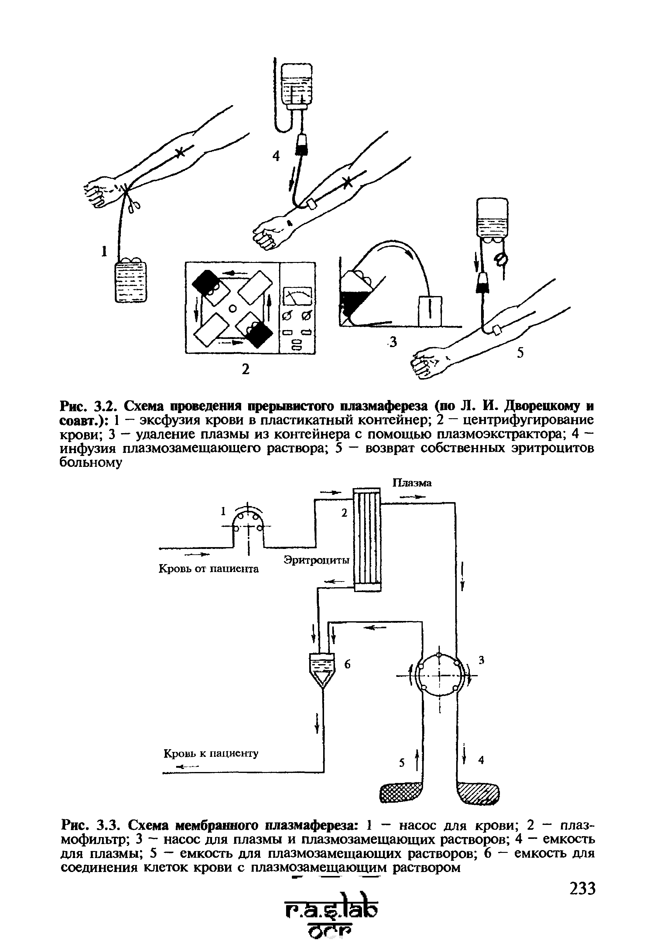 Рис. 3.3. Схема мембранного плазмафереза 1 — насос для крови 2 — плаз-мофильтр 3 — насос для плазмы и плазмозамещающих растворов 4 — емкость для плазмы 5 — емкость для плазмозамещающих растворов 6 — емкость для соединения клеток крови с плазмозамещающим раствором...