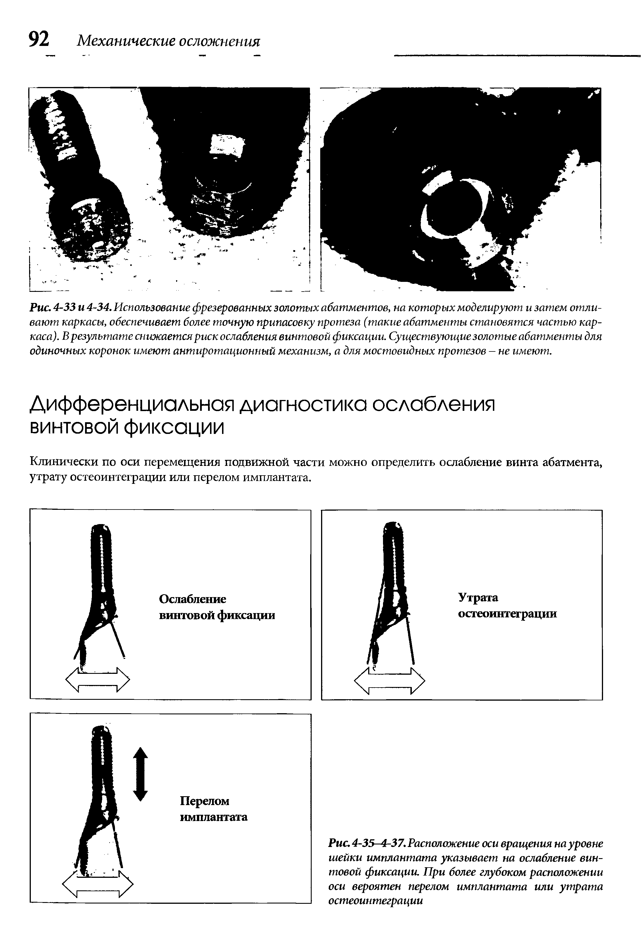 Рис. 4-35—4-37. Расположение оси вращения на уровне шейки имплантата указывает на ослабление винтовой фиксации. При более глубоком расположении оси вероятен перелом имплантата или утрата остеоинтеграции...
