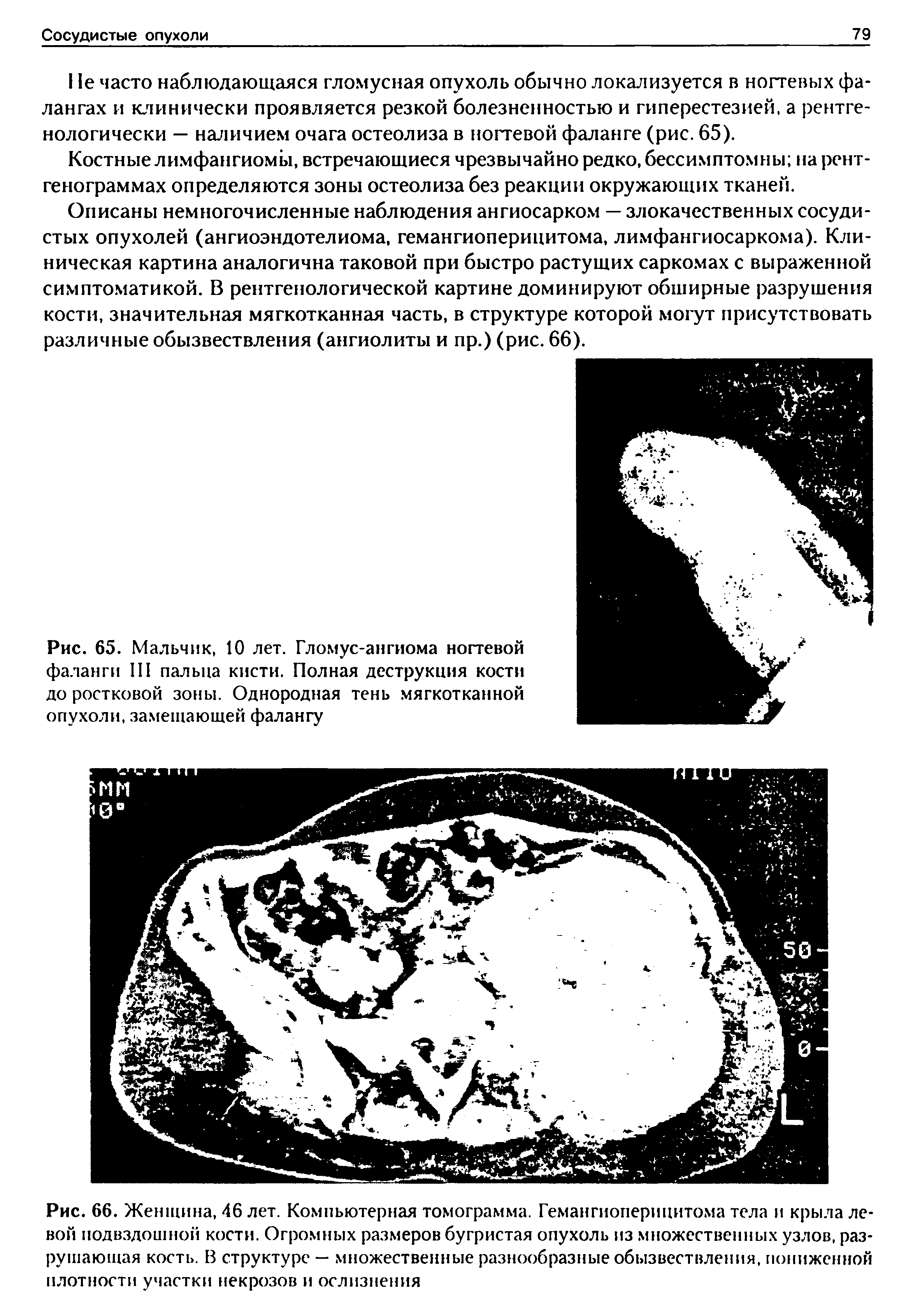 Рис. 65. Мальчик, 10 лет. Гломус-ангиома ногтевой фаланги III пальца кисти. Полная деструкция кости до ростковой зоны. Однородная тень мягкотканной опухоли, замещающей фалангу...