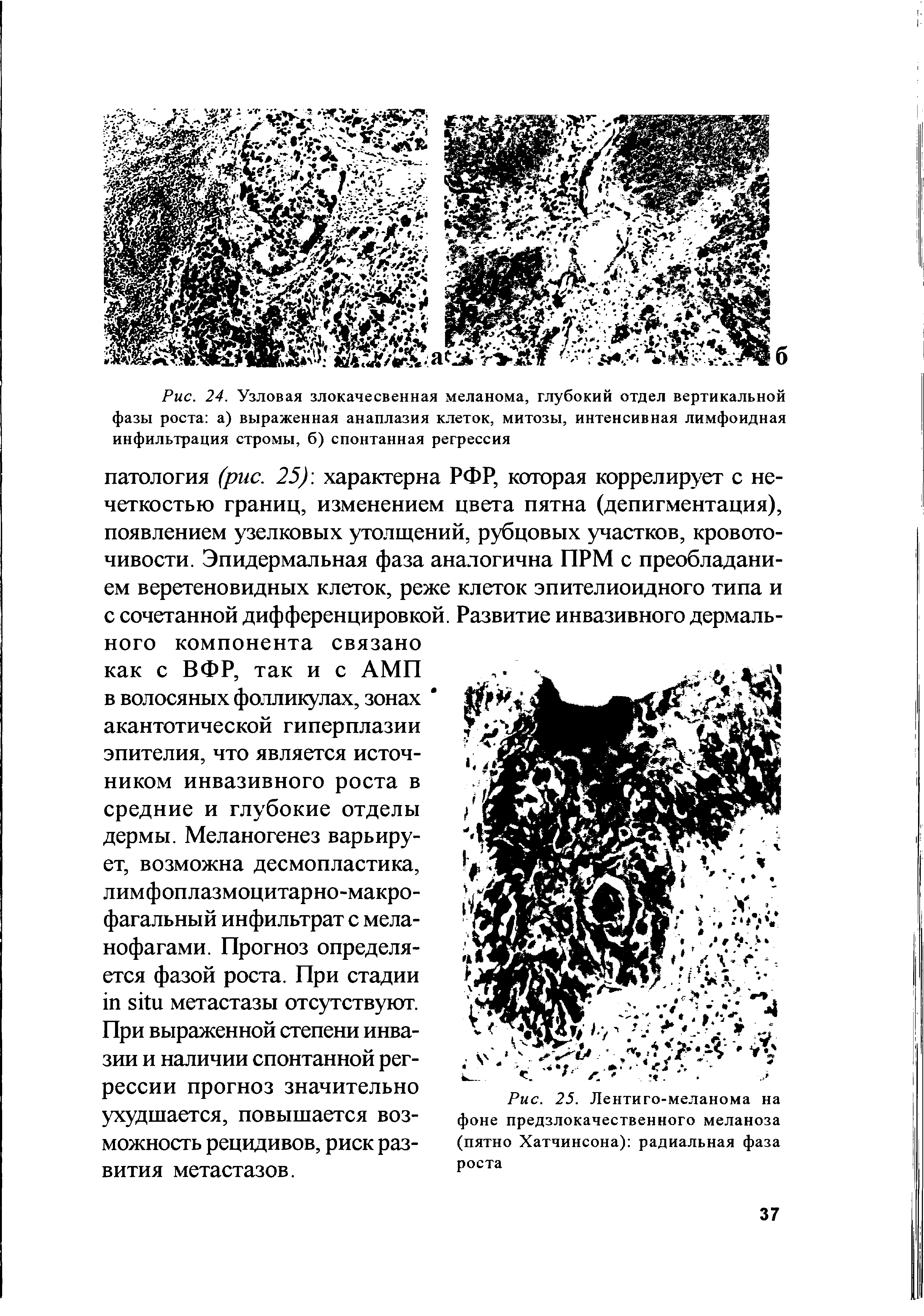 Рис. 25. Лентиго-меланома на фоне предзлокачественного меланоза (пятно Хатчинсона) радиальная фаза...