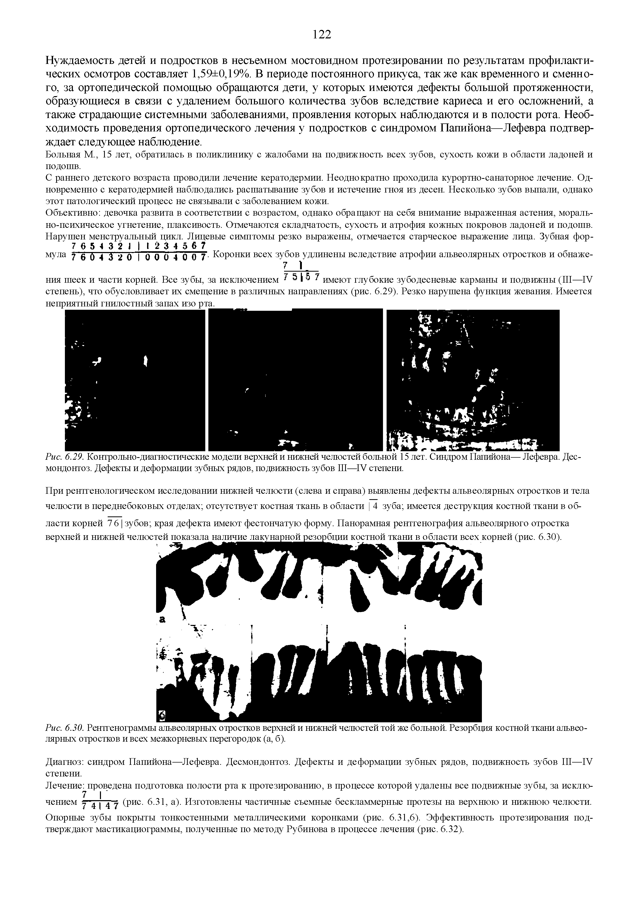 Рис. 6.29. Контрольно-диагностические модели верхней и нижней челюстей больной 15 лет. Синдром Папийона— Лефевра. Дес-мондонтоз. Дефекты и деформации зубных рядов, подвижность зубов III—IV степени.