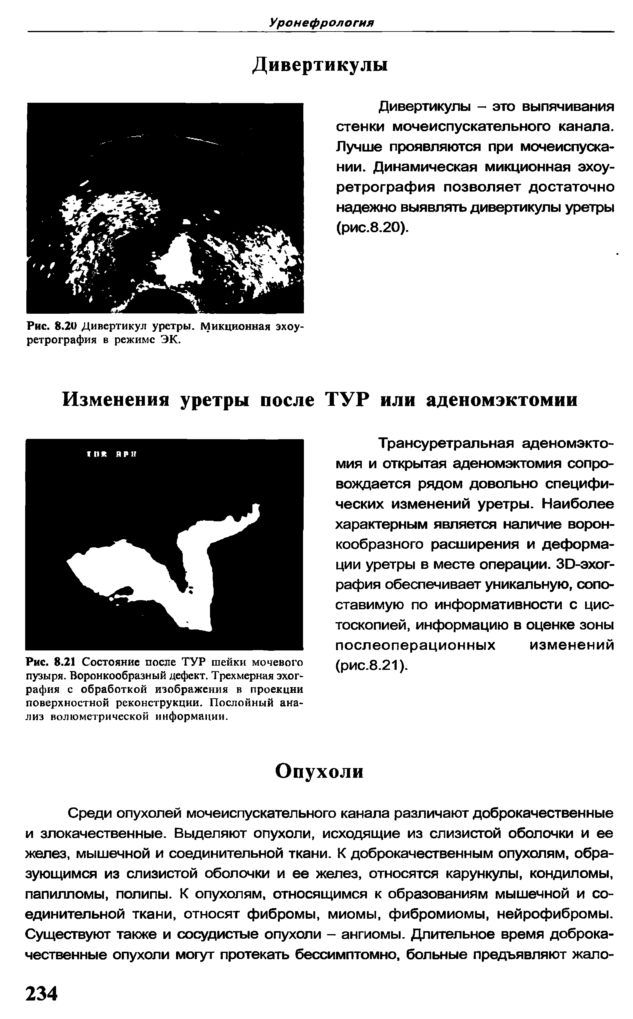 Рис. 8.20 Дивертикул уретры. Микционная эхоу-ретрография в режиме ЭК.