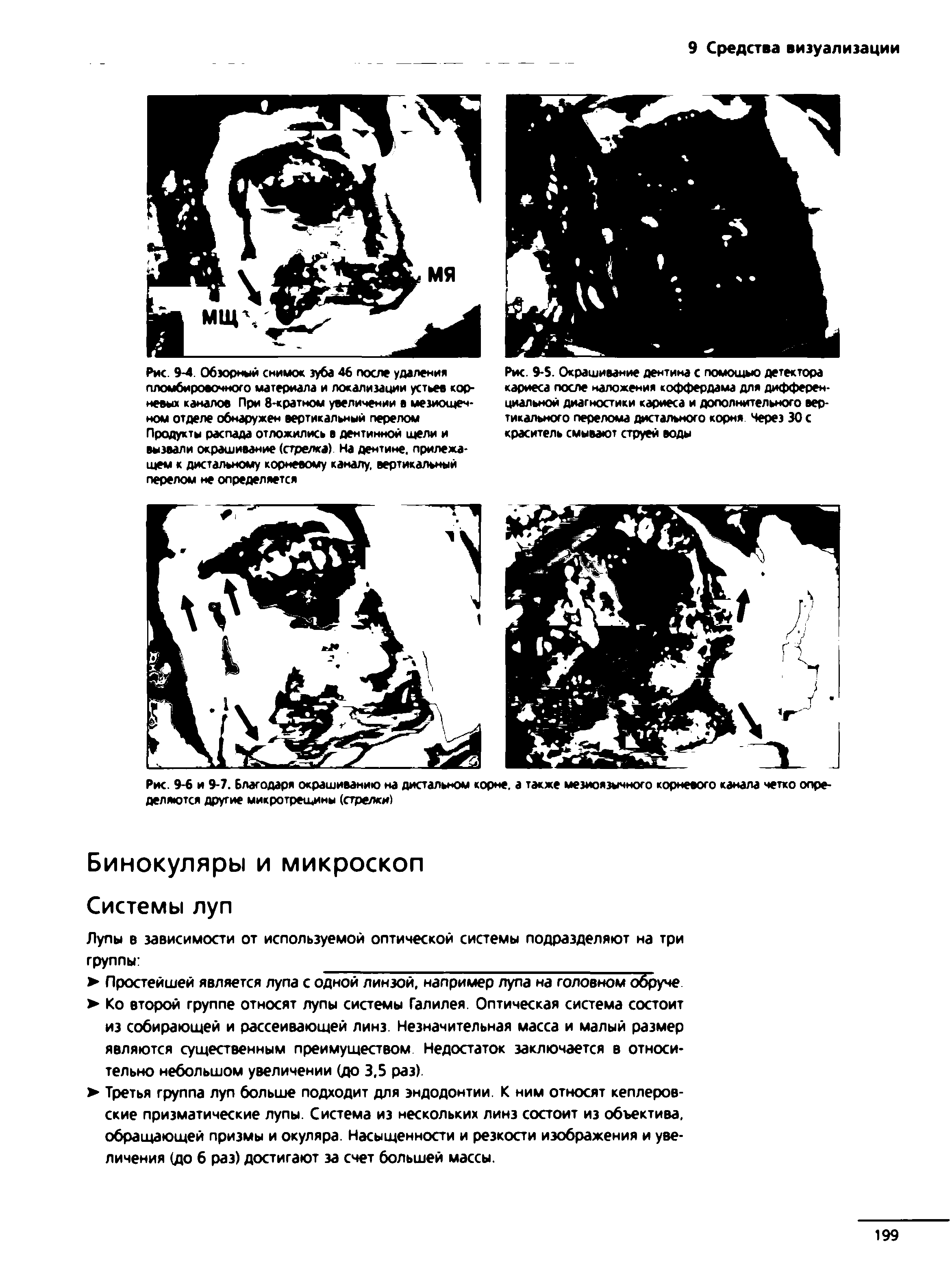 Рис. 9-5. Окрашивание дентина с помощью детектора кариеса после наложения коффердама для дифференциальной диагностики кариеса и дополнительного вертикального перелома дистального корня Через 30 с краситель смывают струей воды...