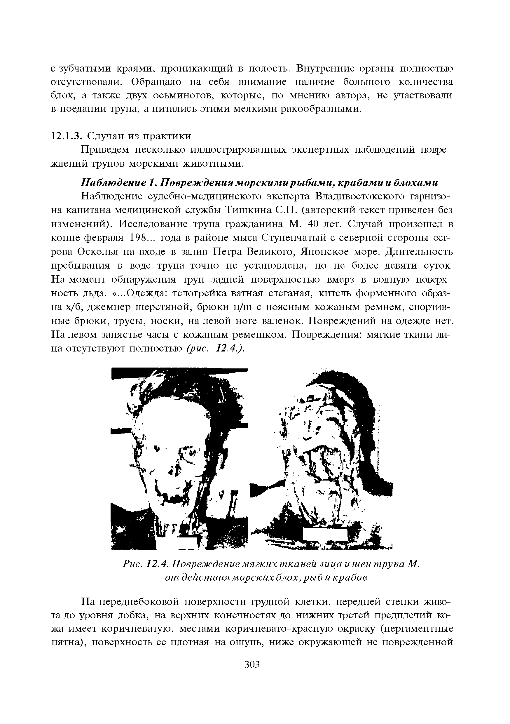 Рис. 12.4. Повреждение мягких тканей лица и шеи трупа М. от действия морских блох, рыб и крабов...