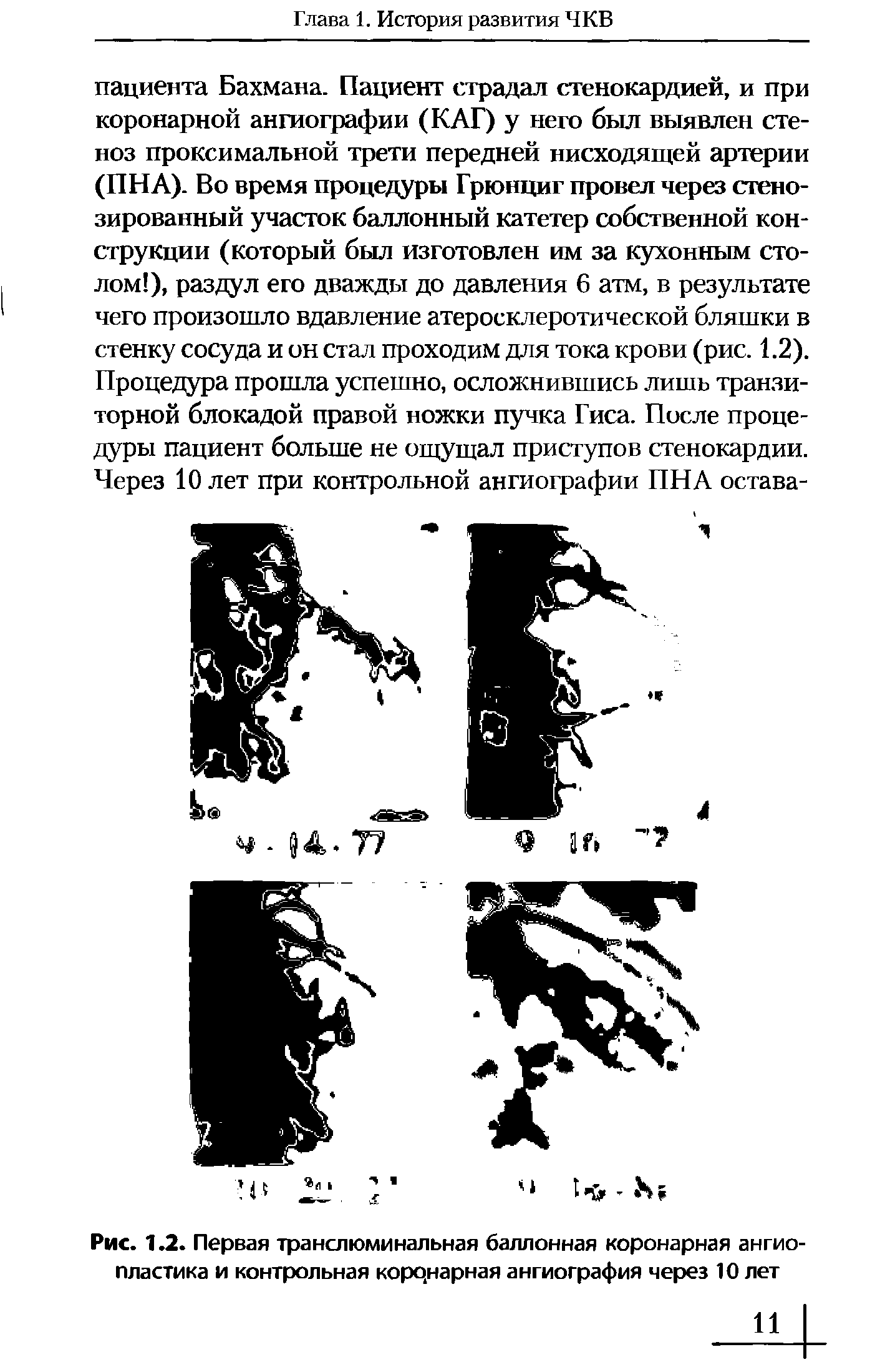 Рис. 1.2. Первая транслюминальная баллонная коронарная ангиопластика и контрольная коронарная ангиография через 10 лет...