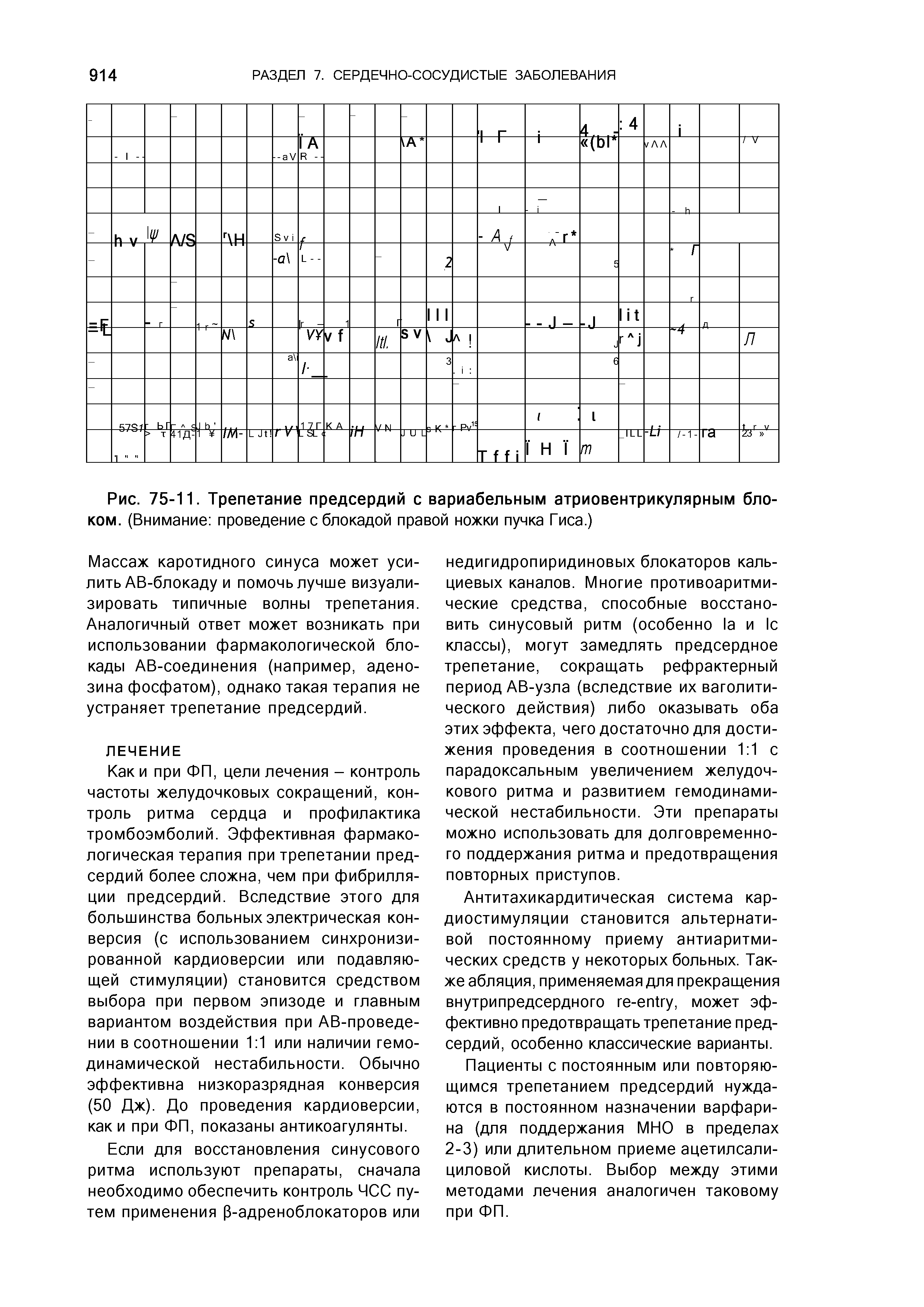 Рис. 75-11. Трепетание предсердий с вариабельным атриовентрикулярным блоком. (Внимание проведение с блокадой правой ножки пучка Гиса.)...